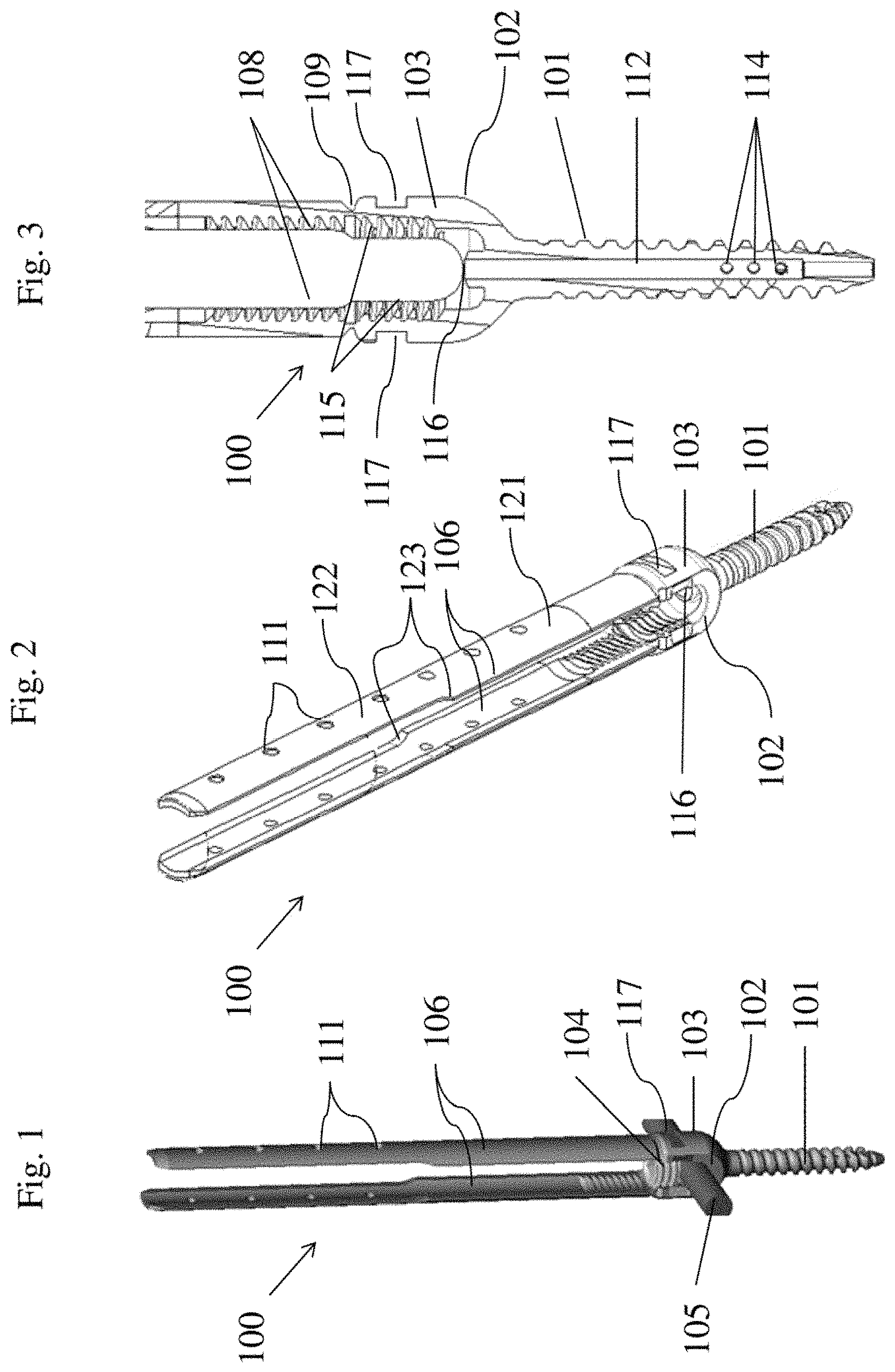 Patent US11771476 Figure 1 – Apparatus and method for fenestrated screw augmentation