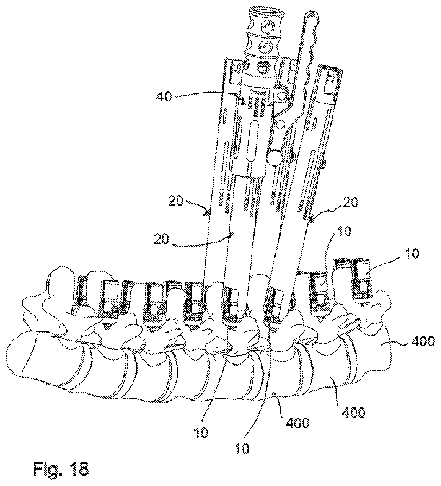 Patent US11771478 Figure 10 – Instrument for locking and unlocking a head of a bone anchor in a polyaxial bone anchoring device