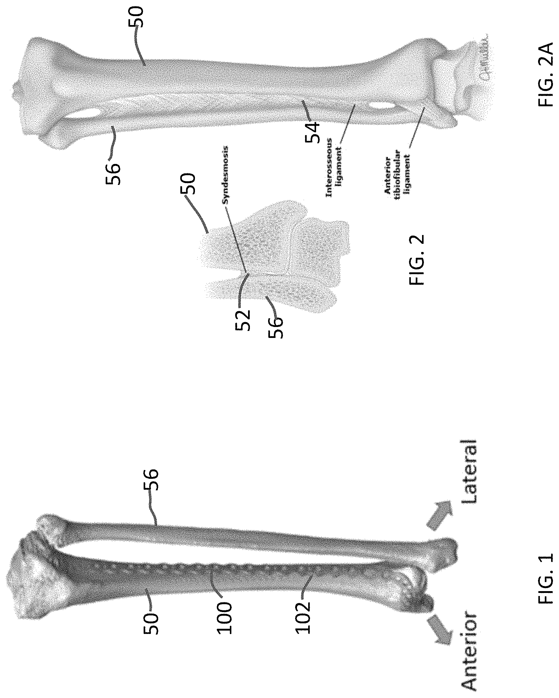 Patent US11771480 Figure 1 – Distal tibial plating system