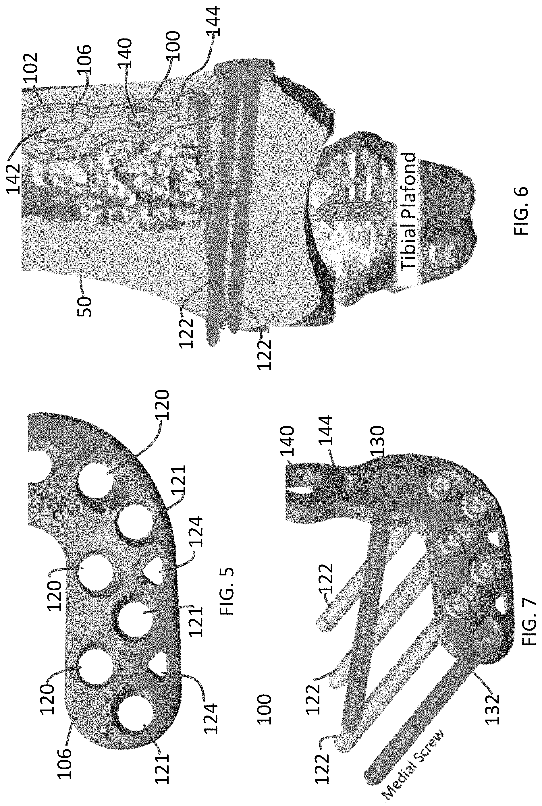 Patent US11771480 Figure 3 – Distal tibial plating system