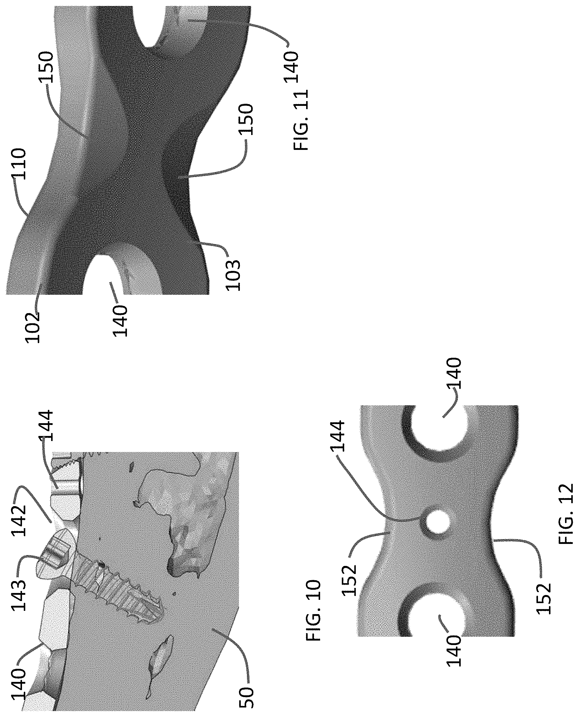 Patent US11771480 Figure 5 – Distal tibial plating system
