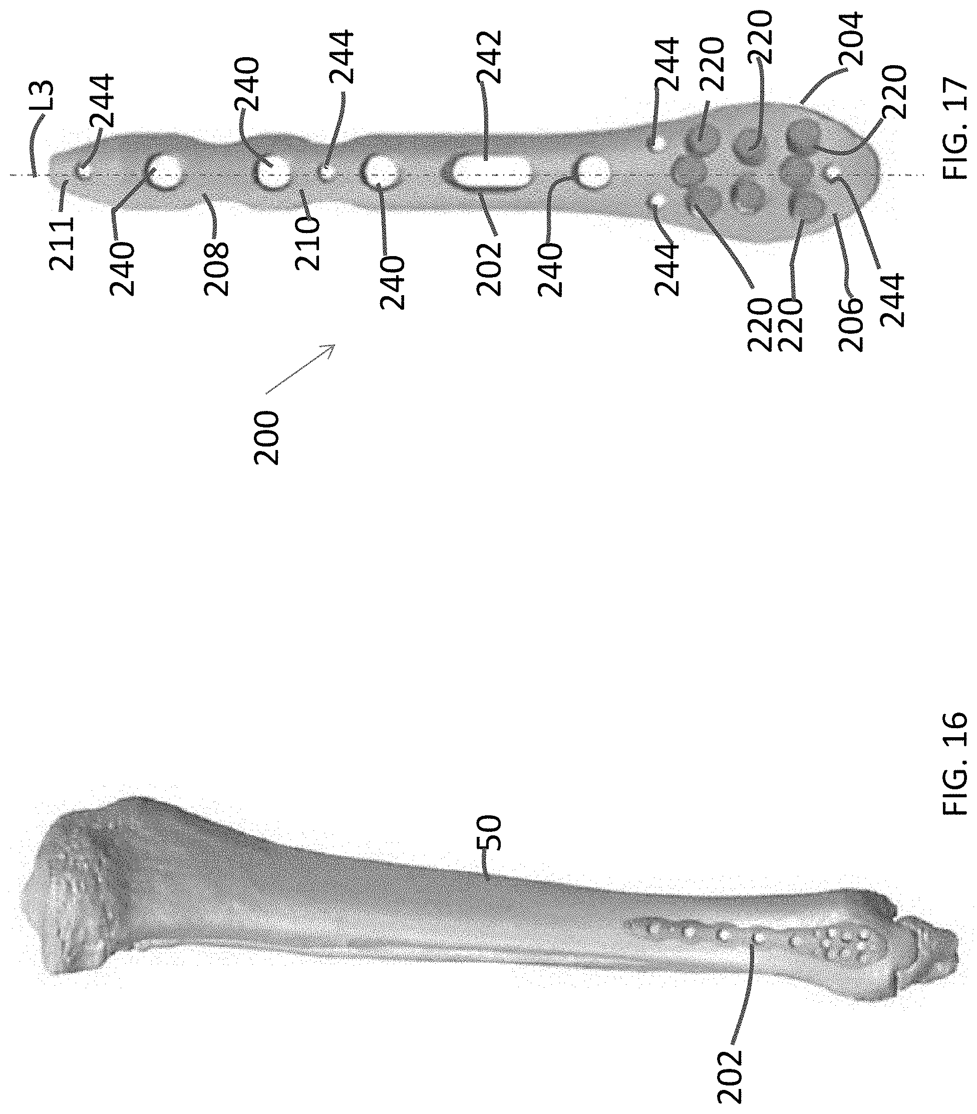 Patent US11771480 Figure 7 – Distal tibial plating system