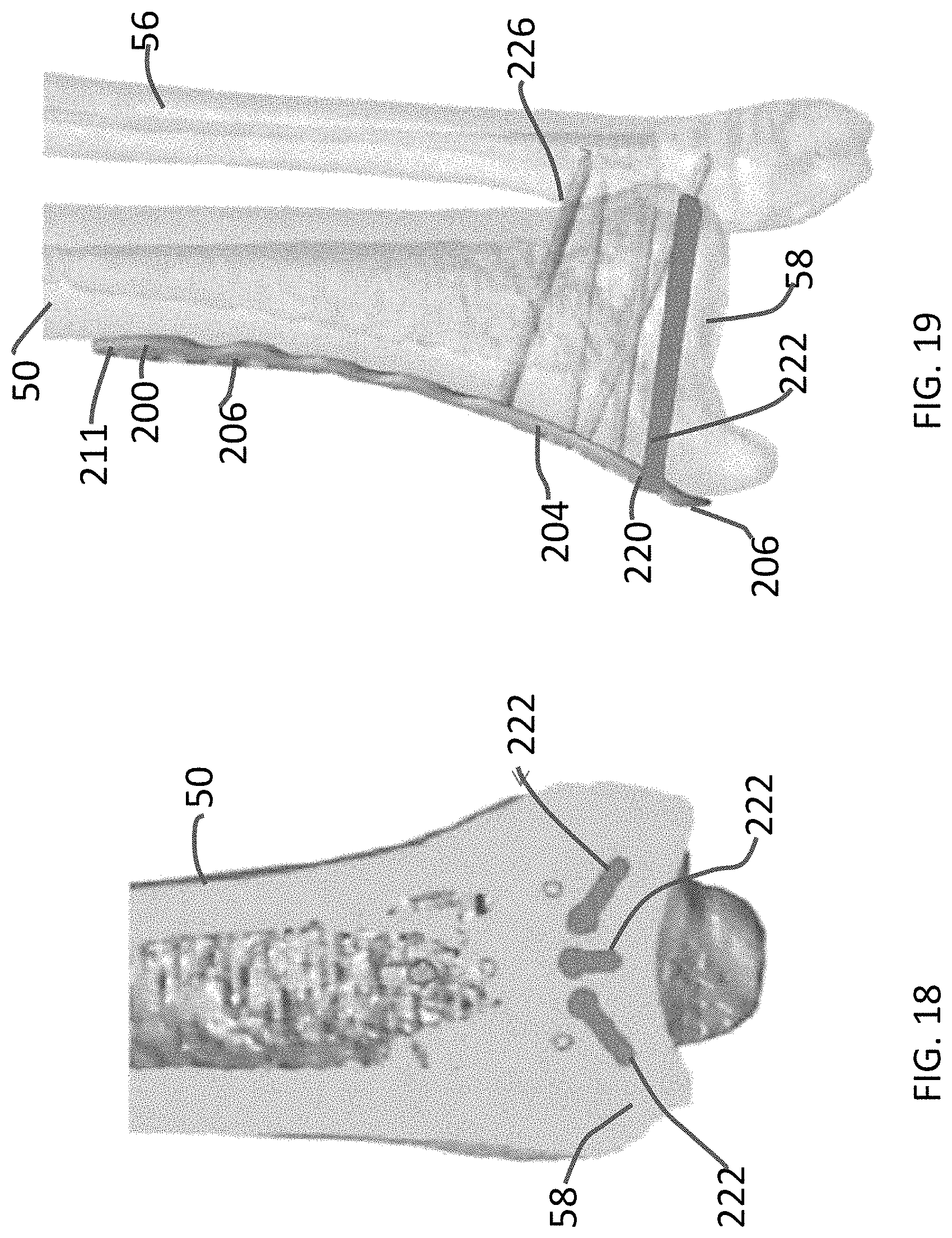 Patent US11771480 Figure 8 – Distal tibial plating system