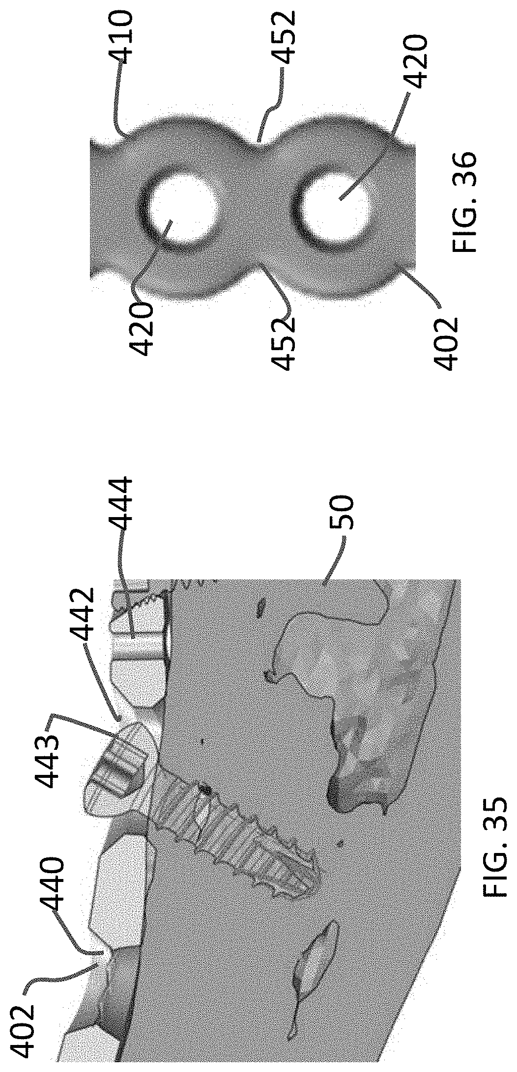 Patent US11771480 Figure 17 – Distal tibial plating system