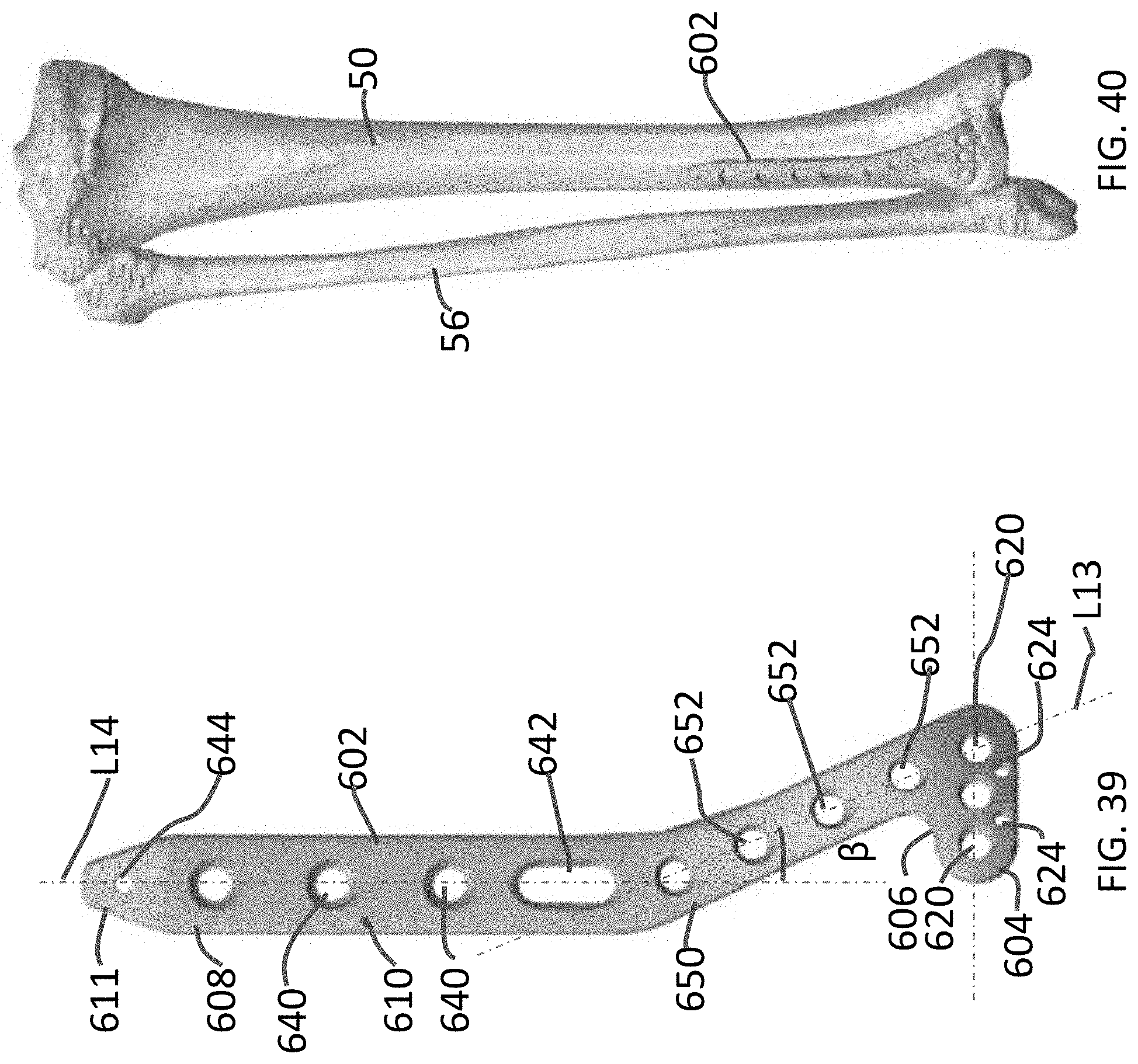Patent US11771480 Figure 19 – Distal tibial plating system