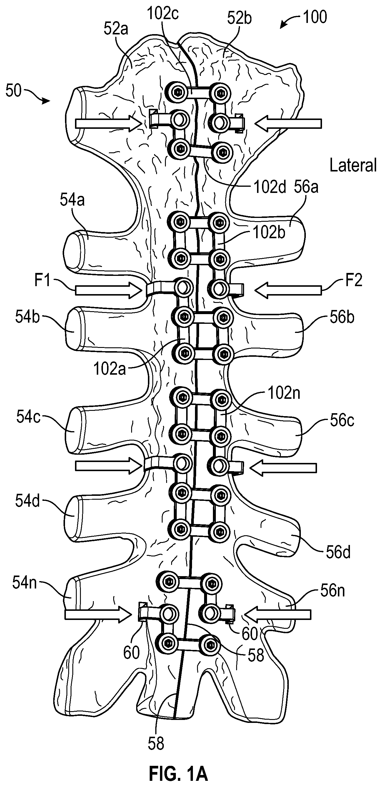 Patent US11771481 Figure 1 – Sternal plates and methods of use