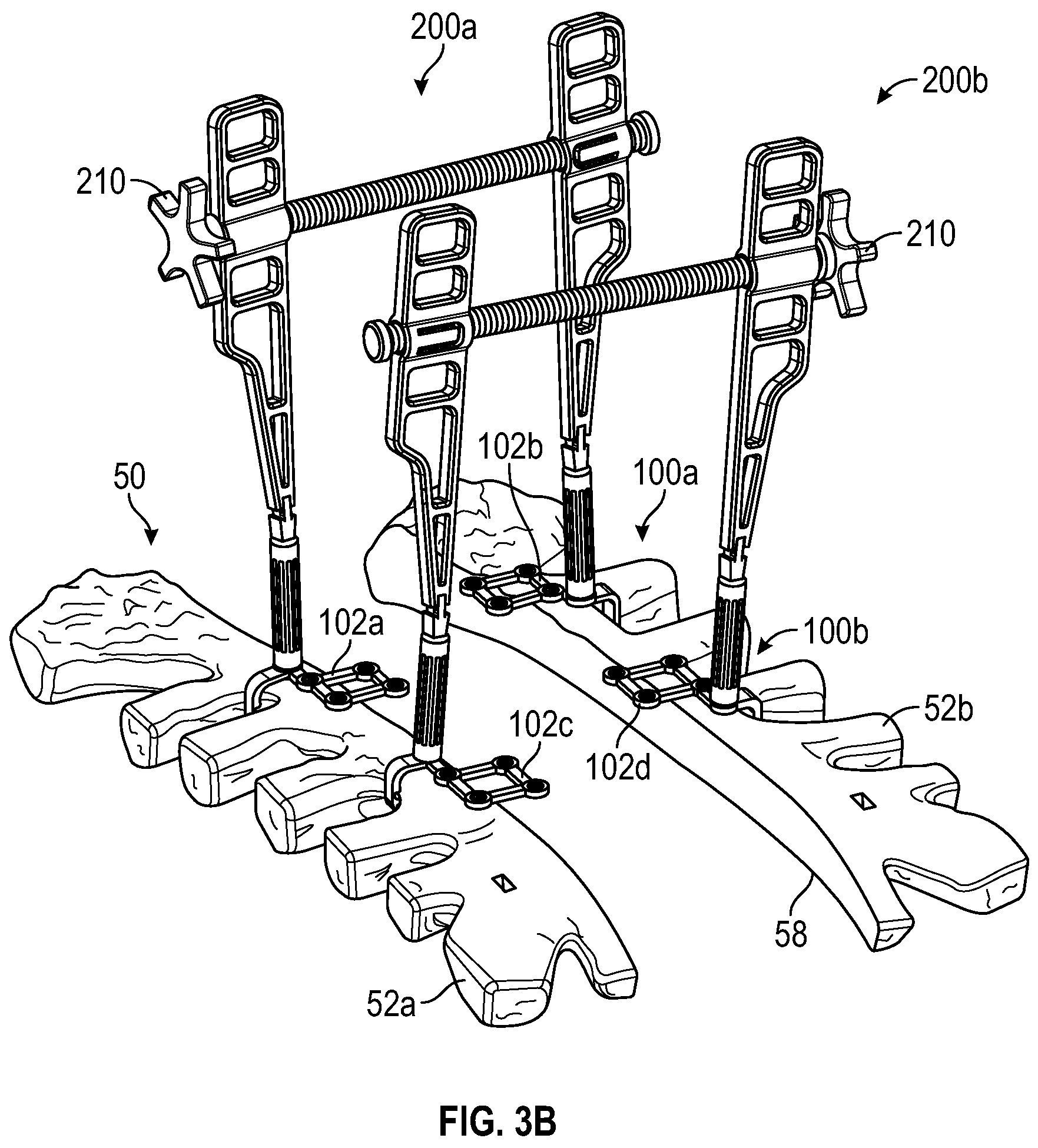Patent US11771481 Figure 8 – Sternal plates and methods of use