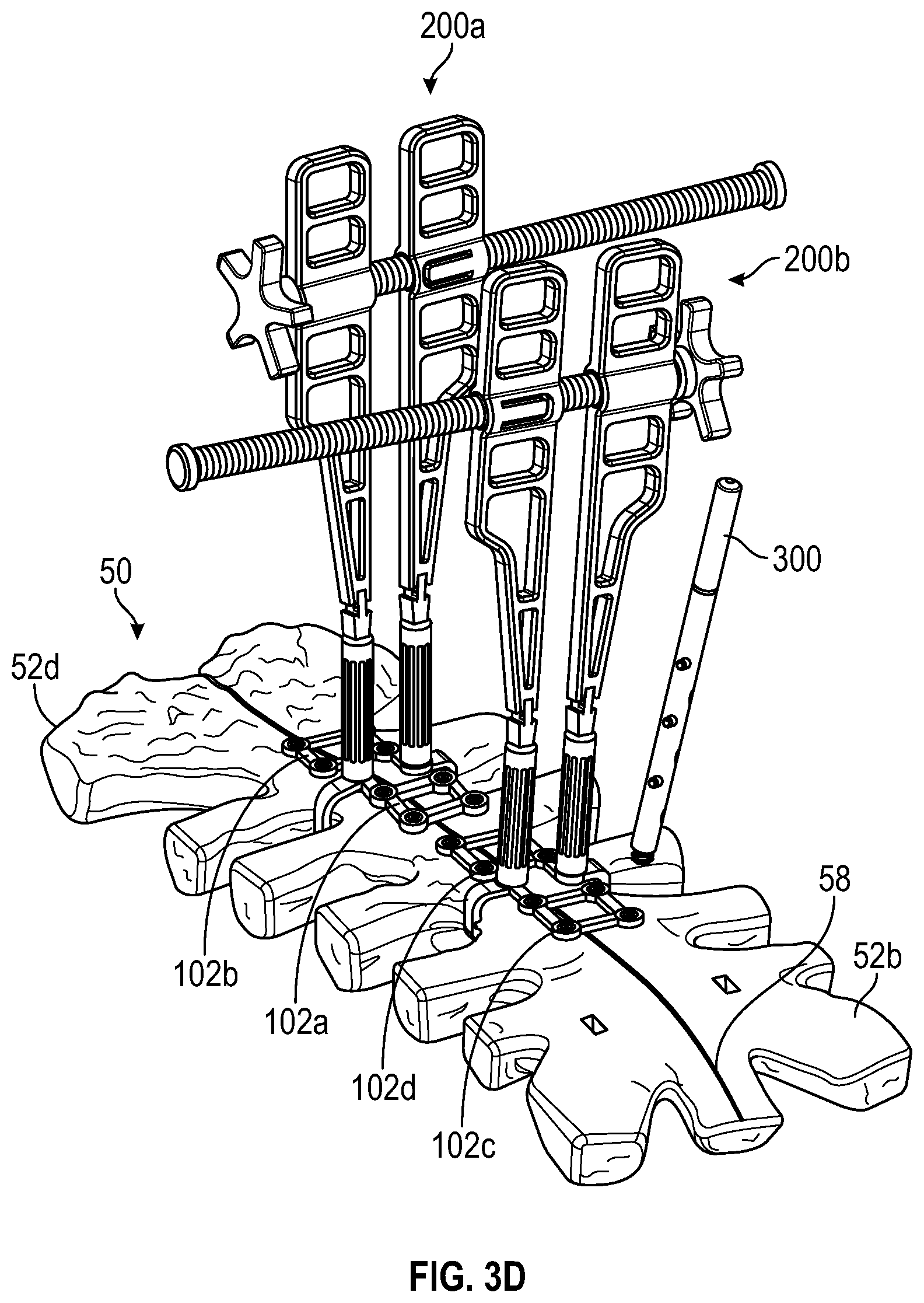 Patent US11771481 Figure 10 – Sternal plates and methods of use