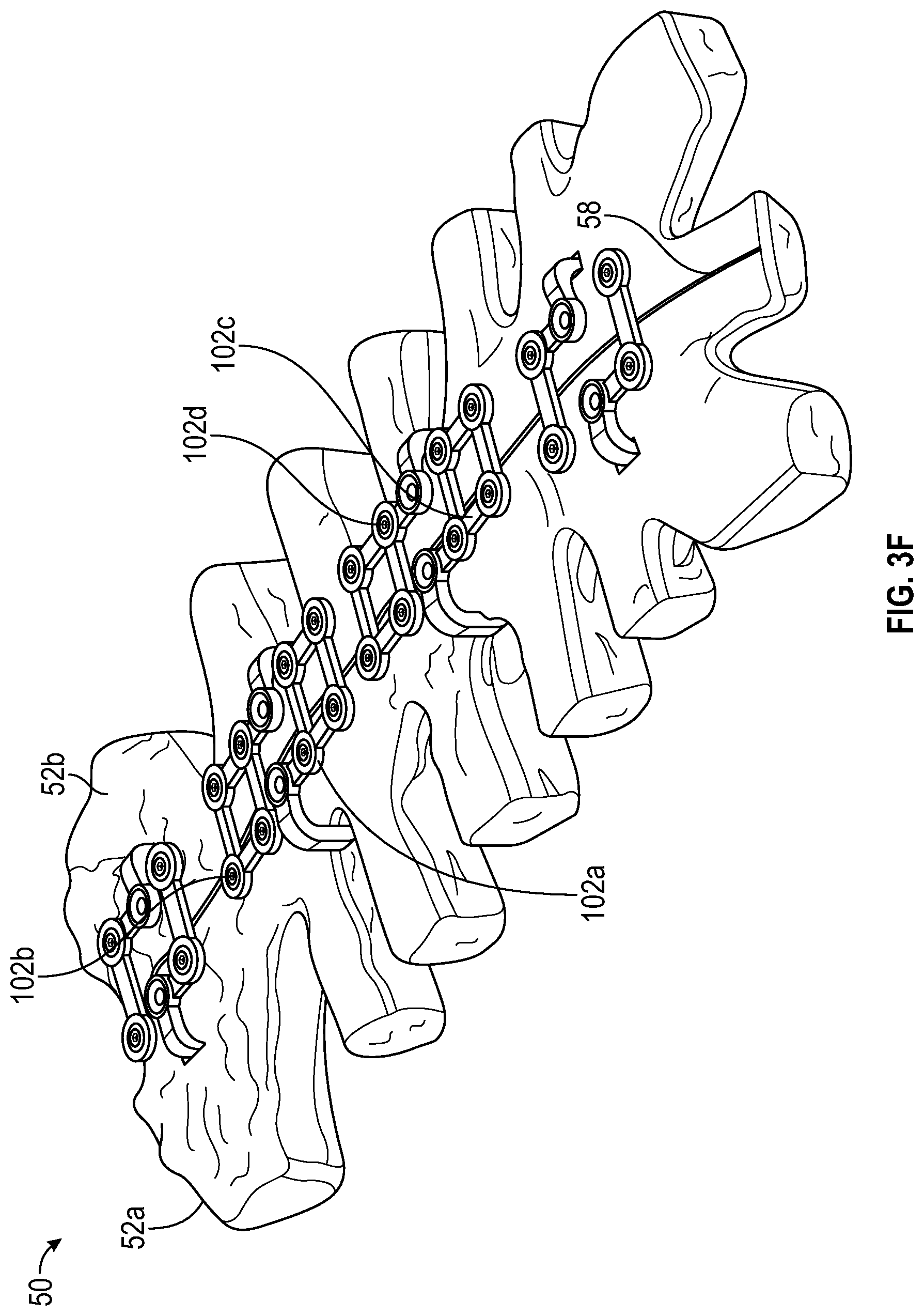 Patent US11771481 Figure 12 – Sternal plates and methods of use