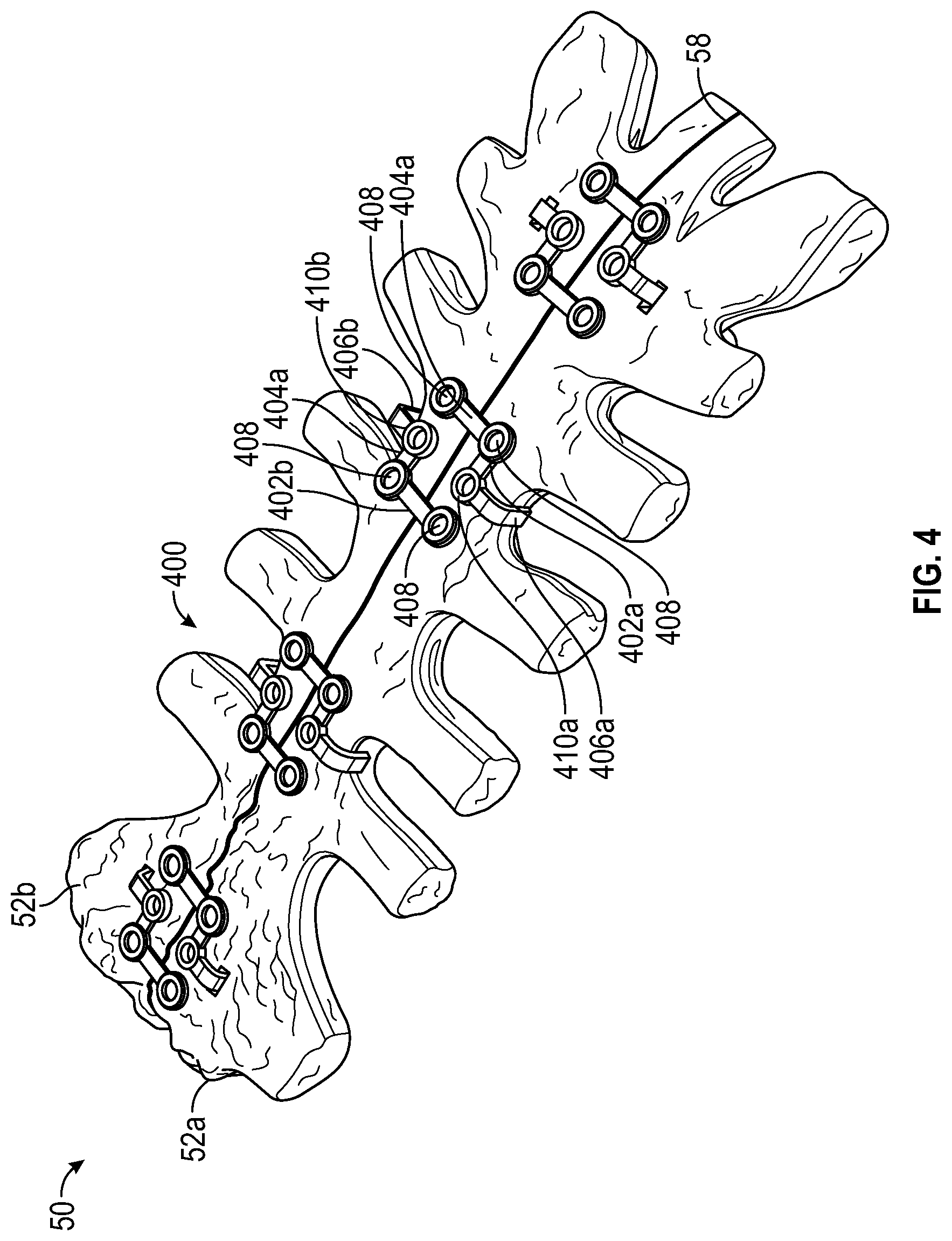 Patent US11771481 Figure 13 – Sternal plates and methods of use