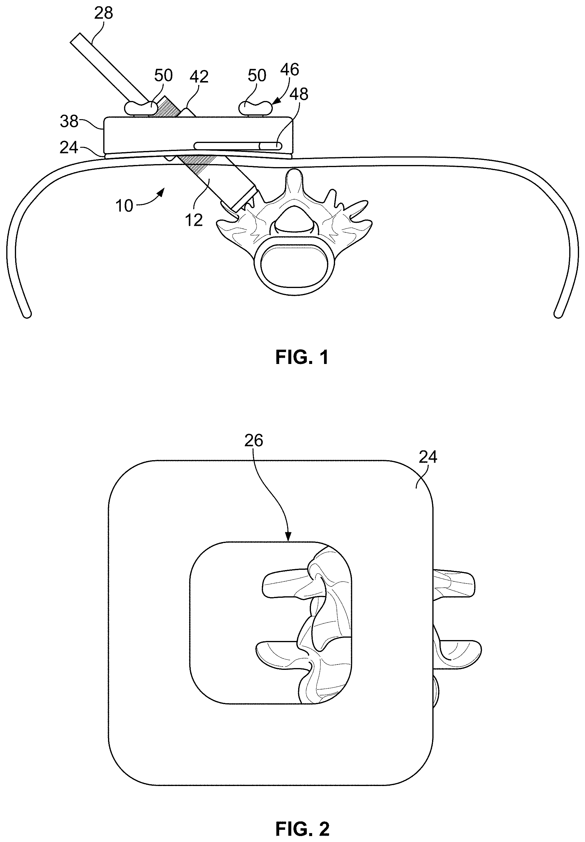 Patent US11771483 Figure 1 – Minimal impact access system to disc space