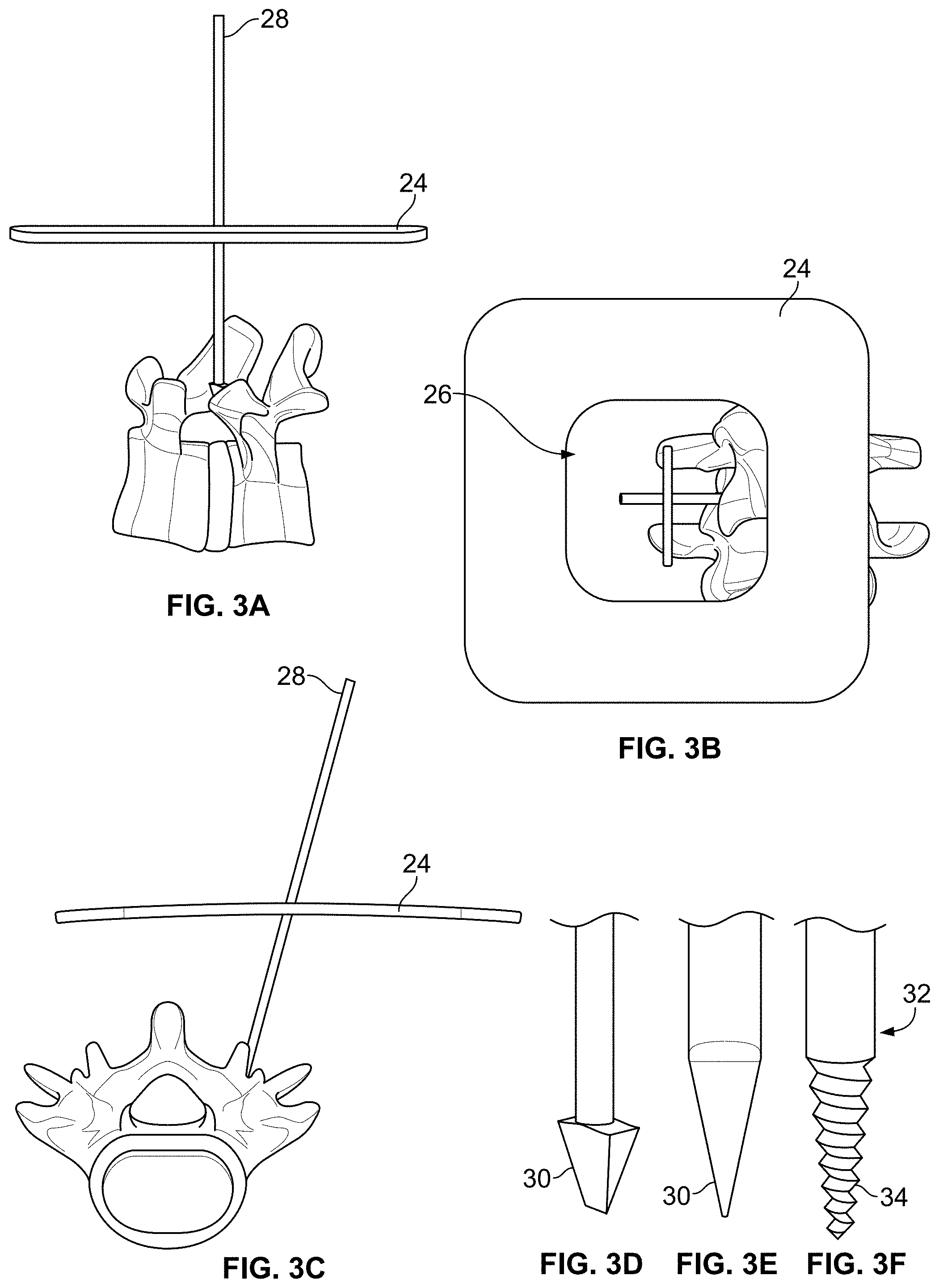 Patent US11771483 Figure 2 – Minimal impact access system to disc space