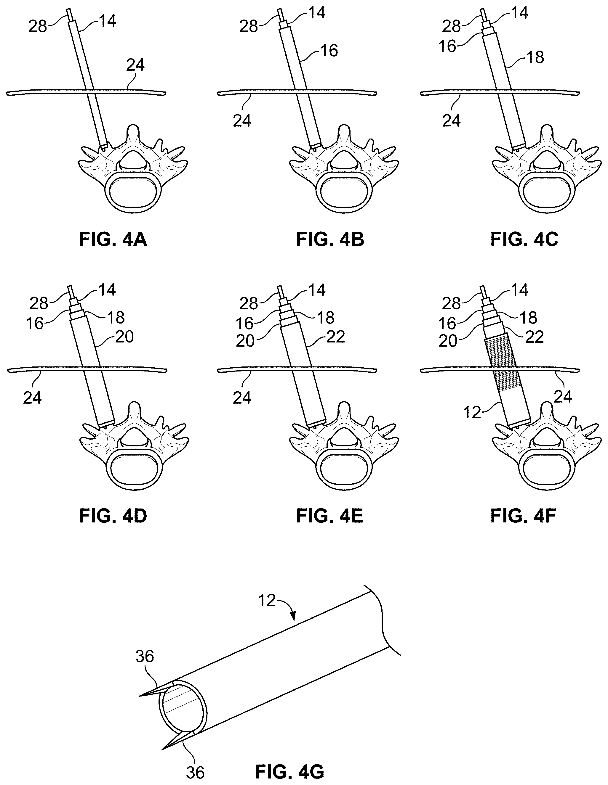 Patent US11771483 Figure 3 – Minimal impact access system to disc space
