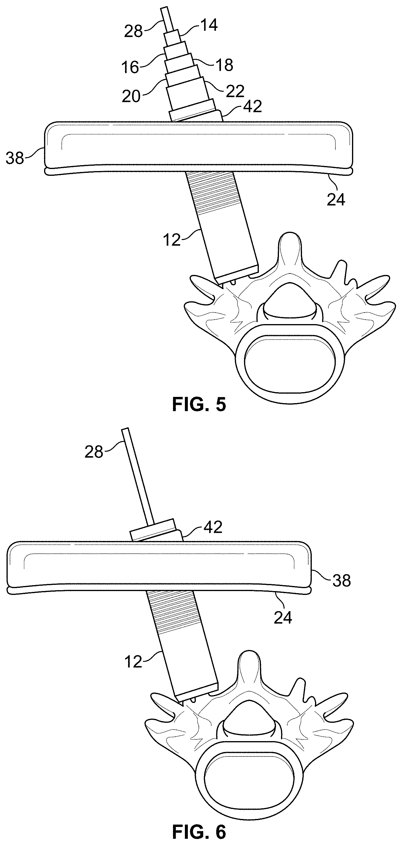 Patent US11771483 Figure 4 – Minimal impact access system to disc space
