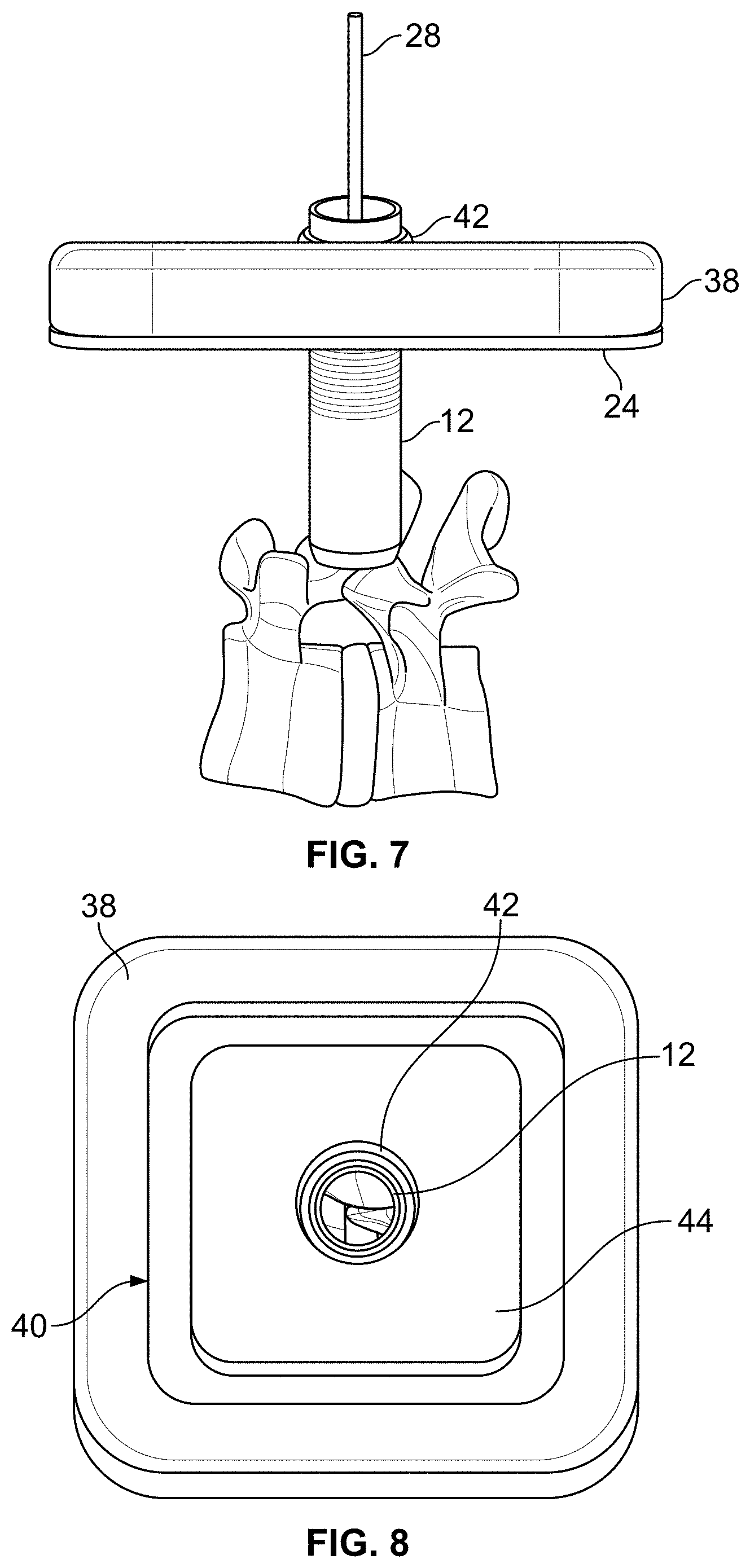 Patent US11771483 Figure 5 – Minimal impact access system to disc space