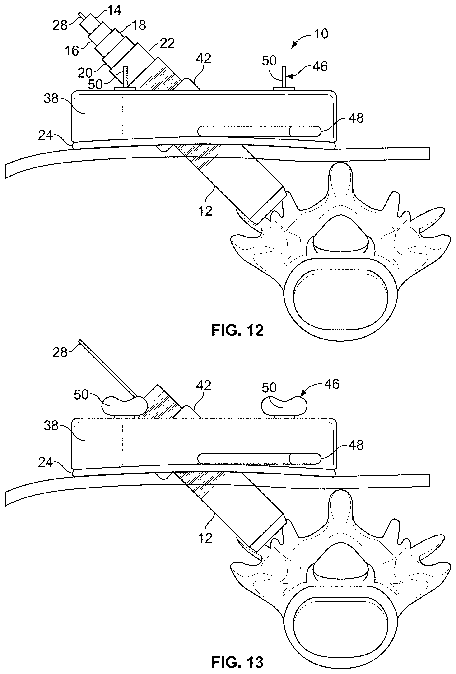 Patent US11771483 Figure 7 – Minimal impact access system to disc space