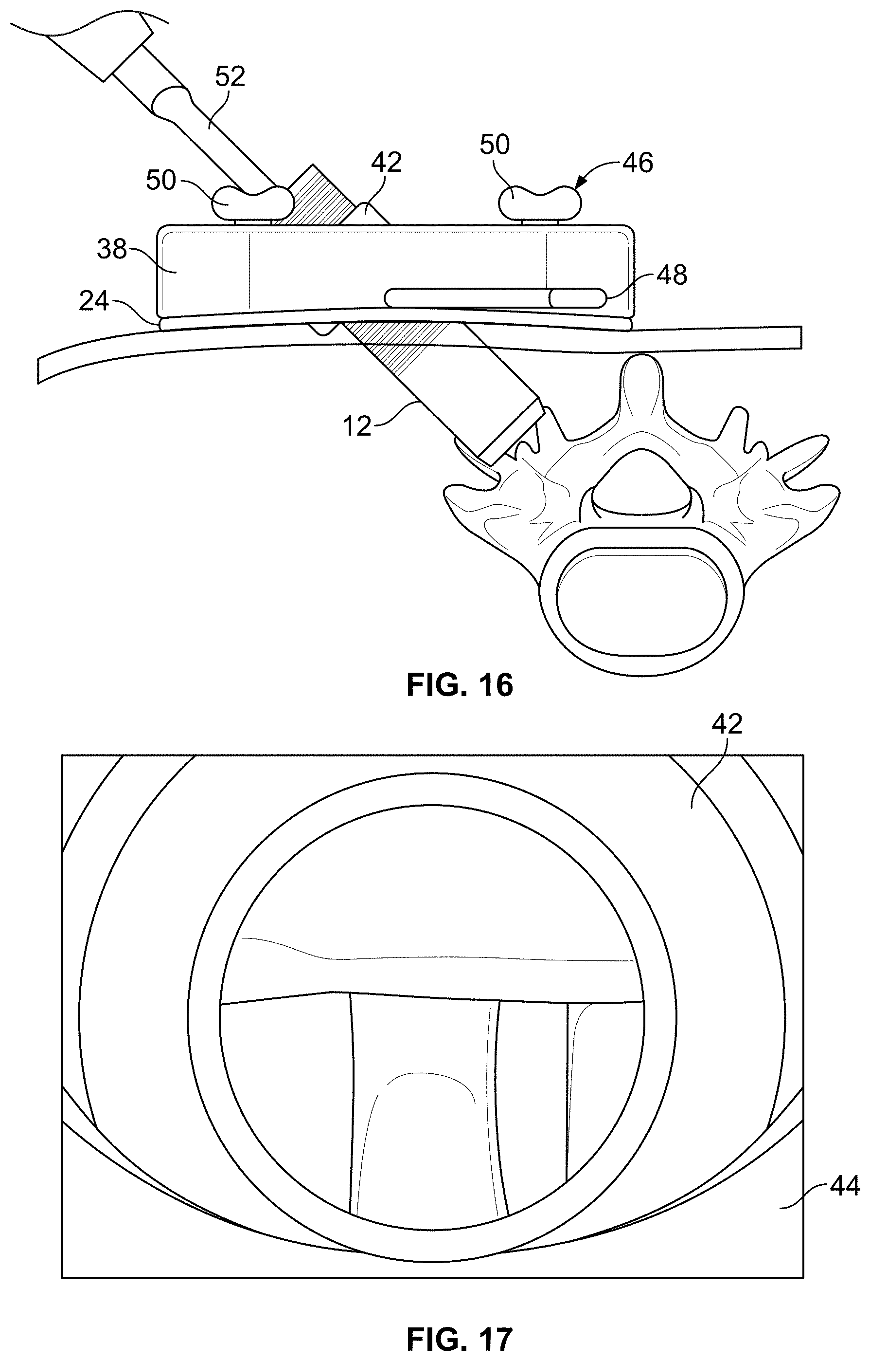 Patent US11771483 Figure 9 – Minimal impact access system to disc space