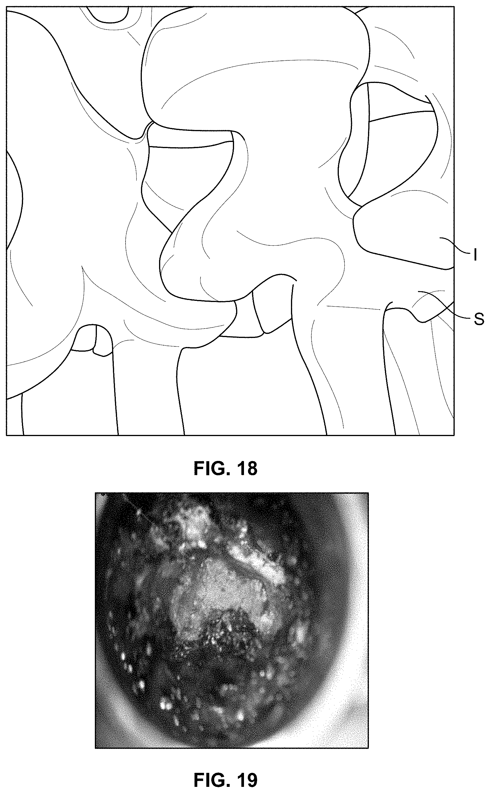 Patent US11771483 Figure 10 – Minimal impact access system to disc space