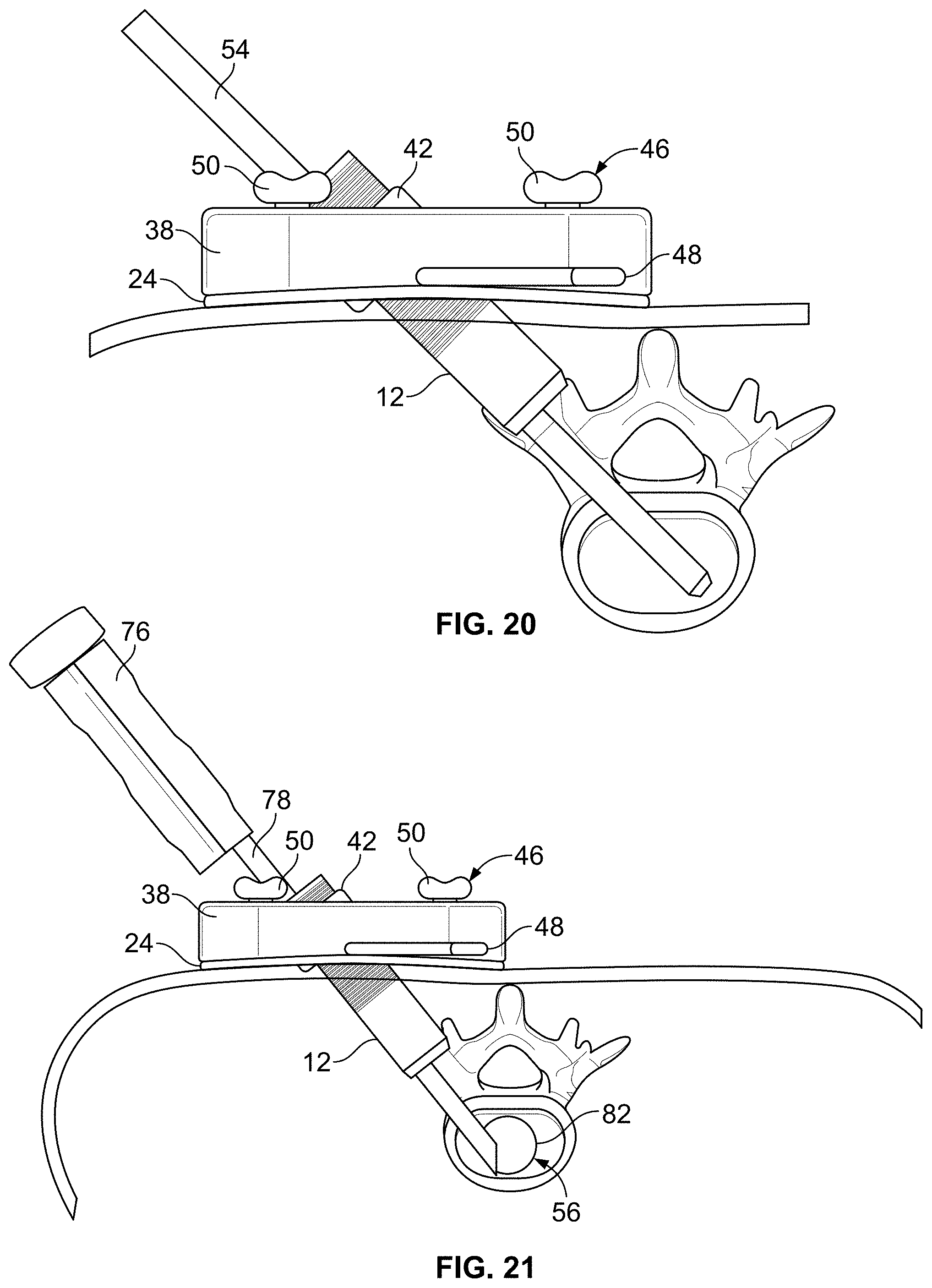 Patent US11771483 Figure 11 – Minimal impact access system to disc space