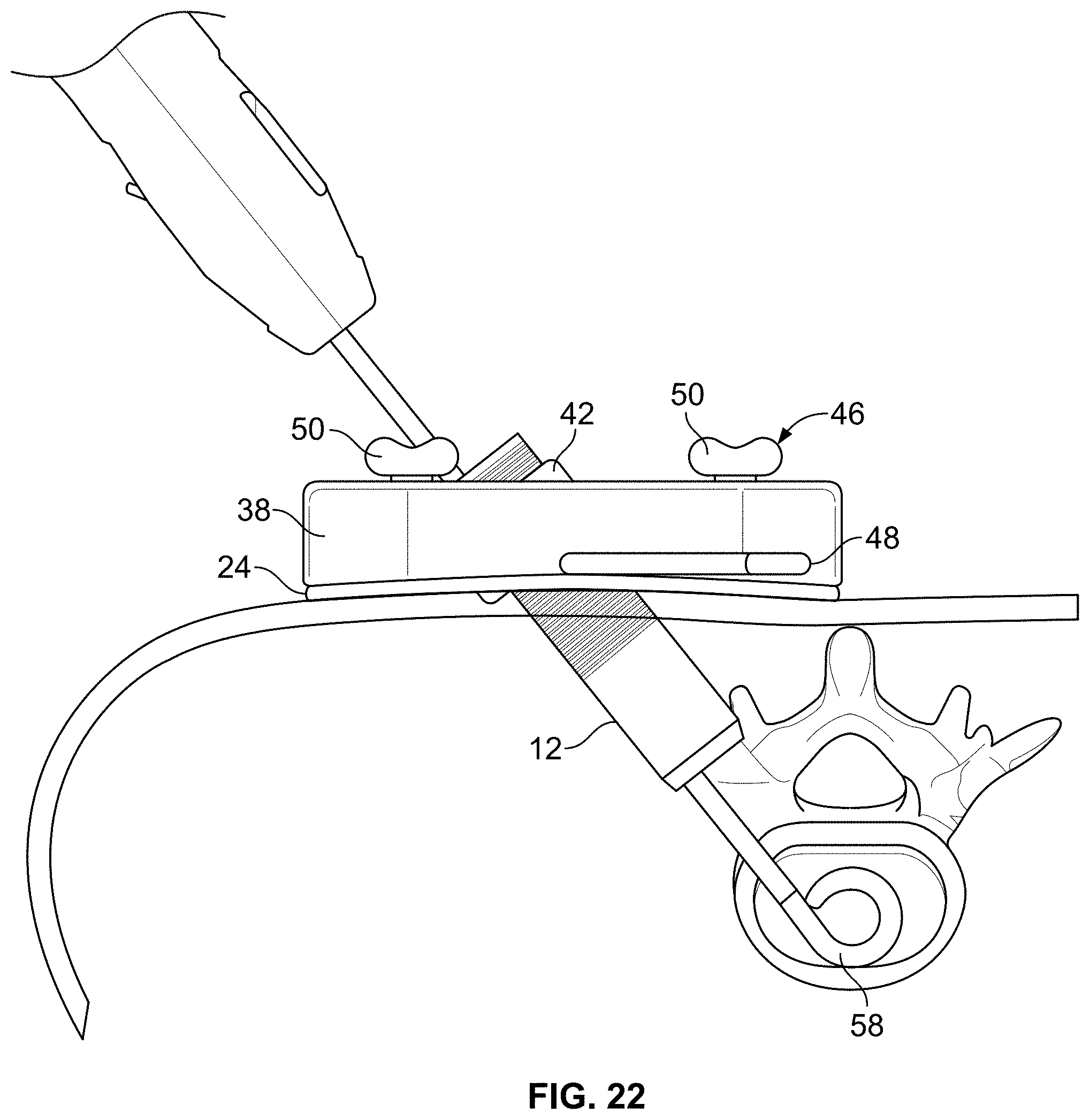 Patent US11771483 Figure 12 – Minimal impact access system to disc space