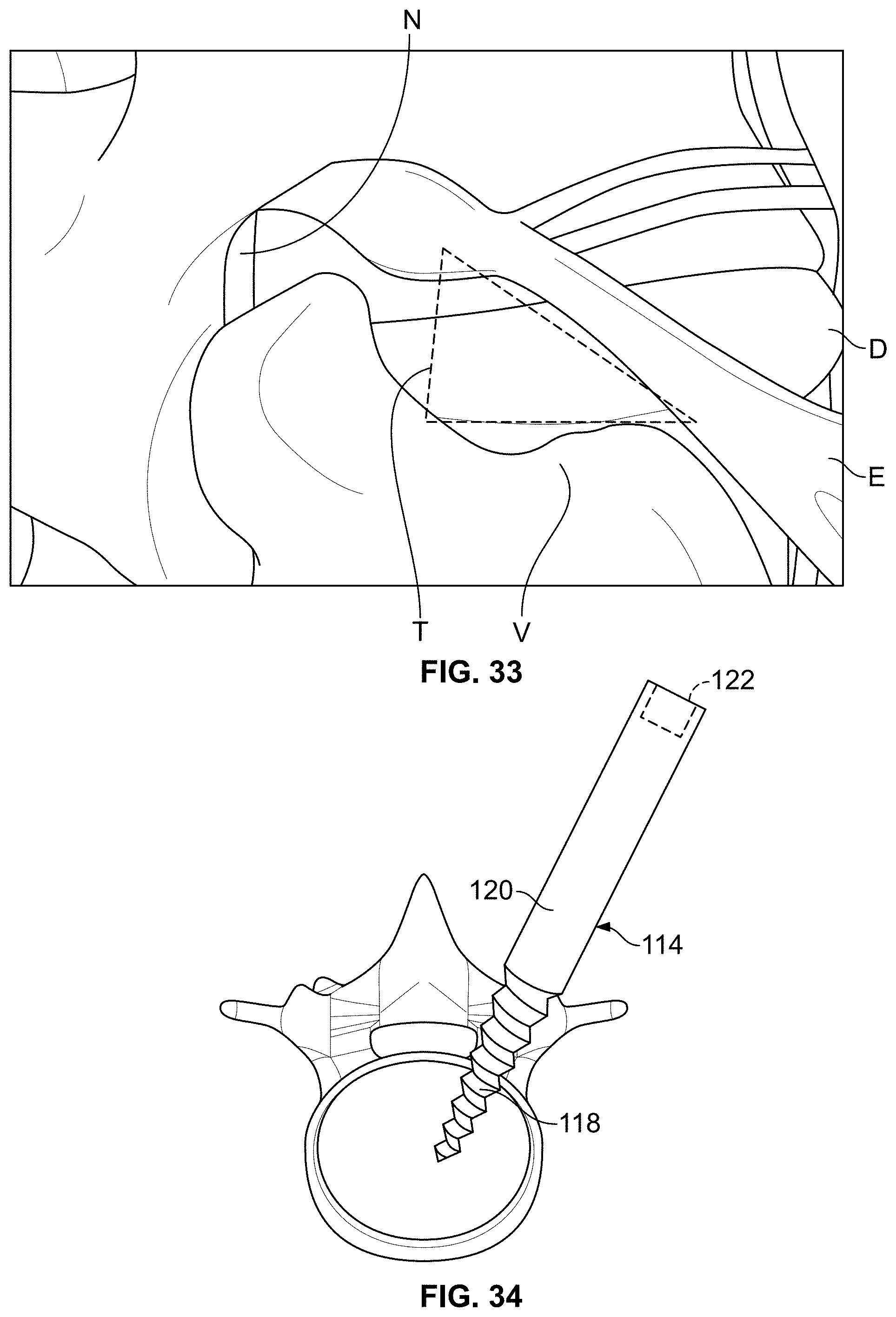 Patent US11771483 Figure 16 – Minimal impact access system to disc space
