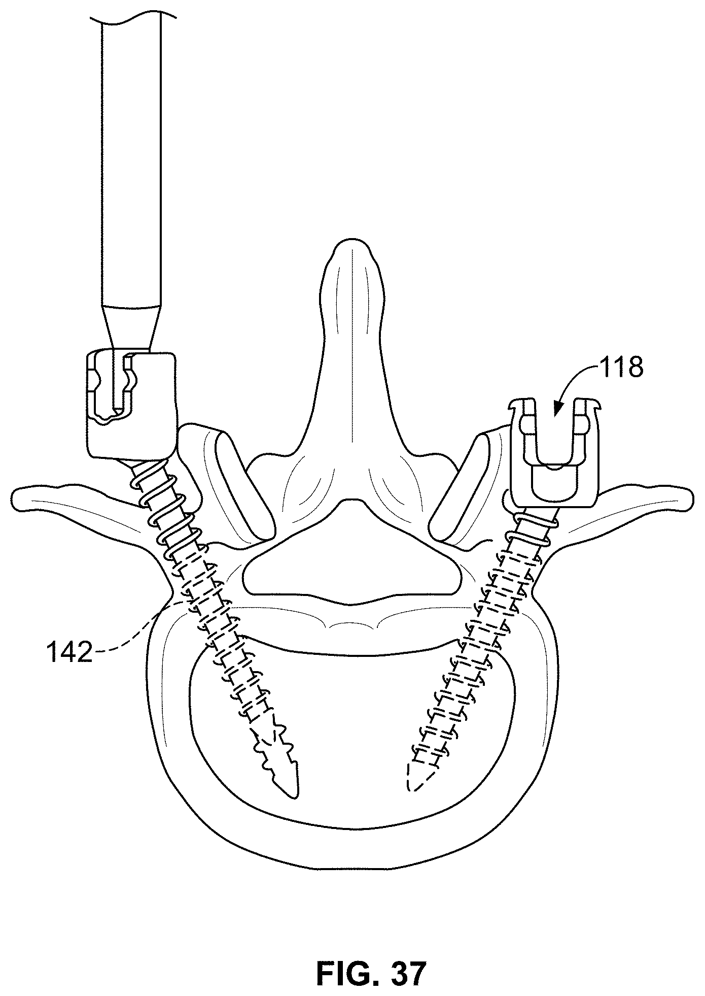 Patent US11771483 Figure 19 – Minimal impact access system to disc space