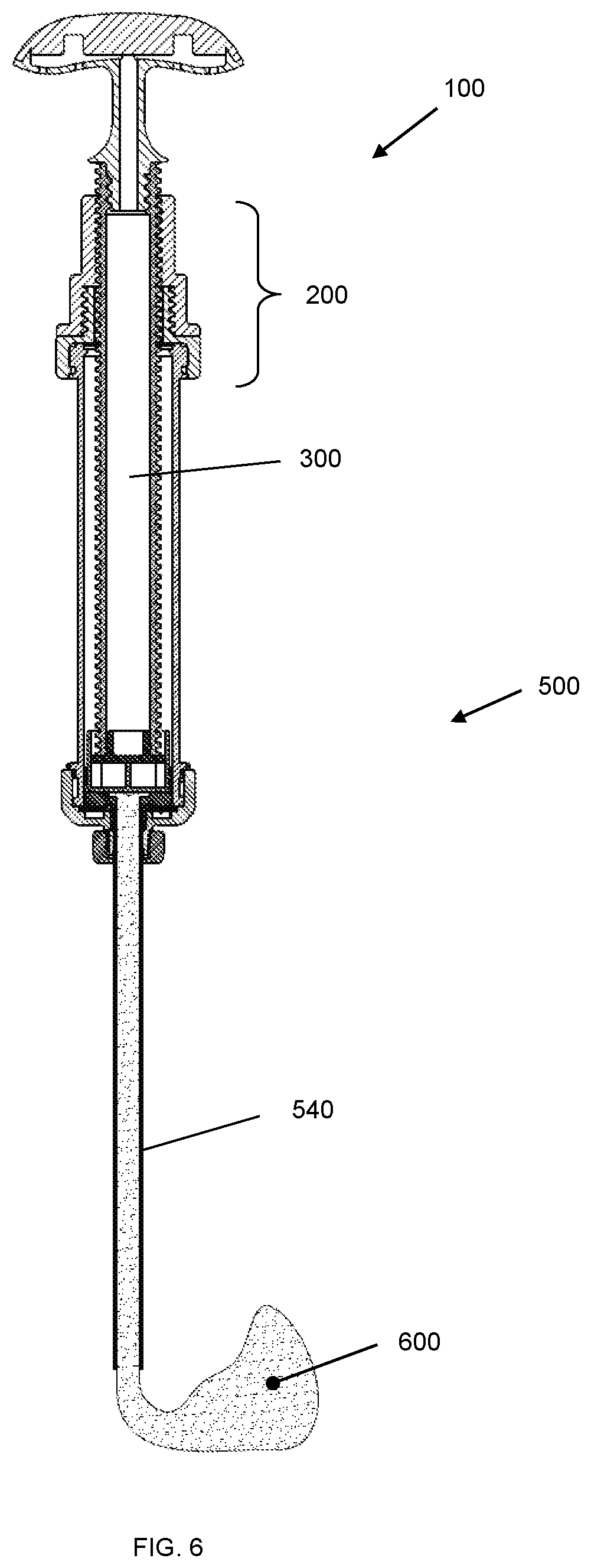 Patent US11771484 Figure 6 – Device for dispensing bone cement