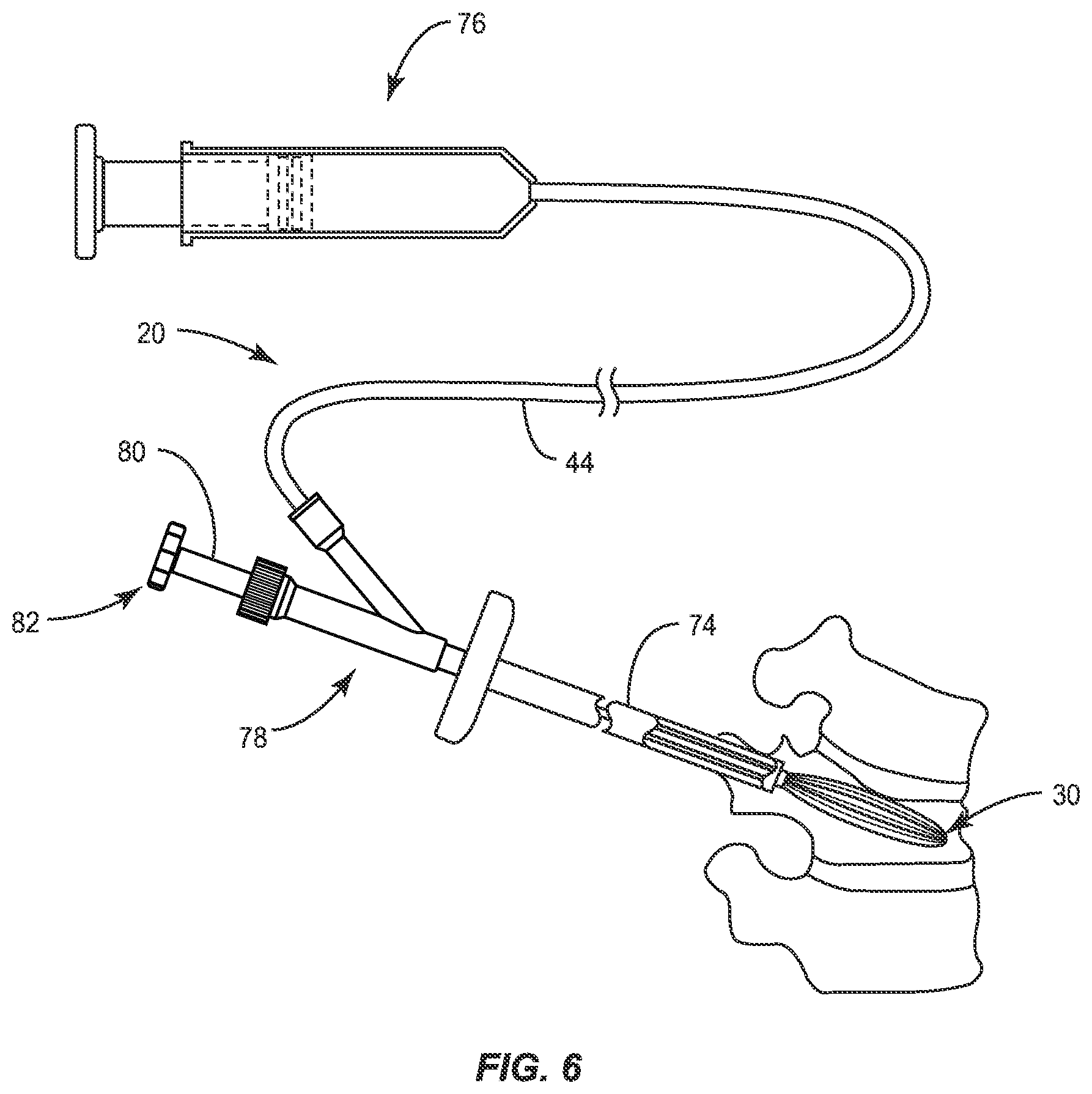 Patent US11771485 Figure 6 – Device for performing a surgical procedure and method