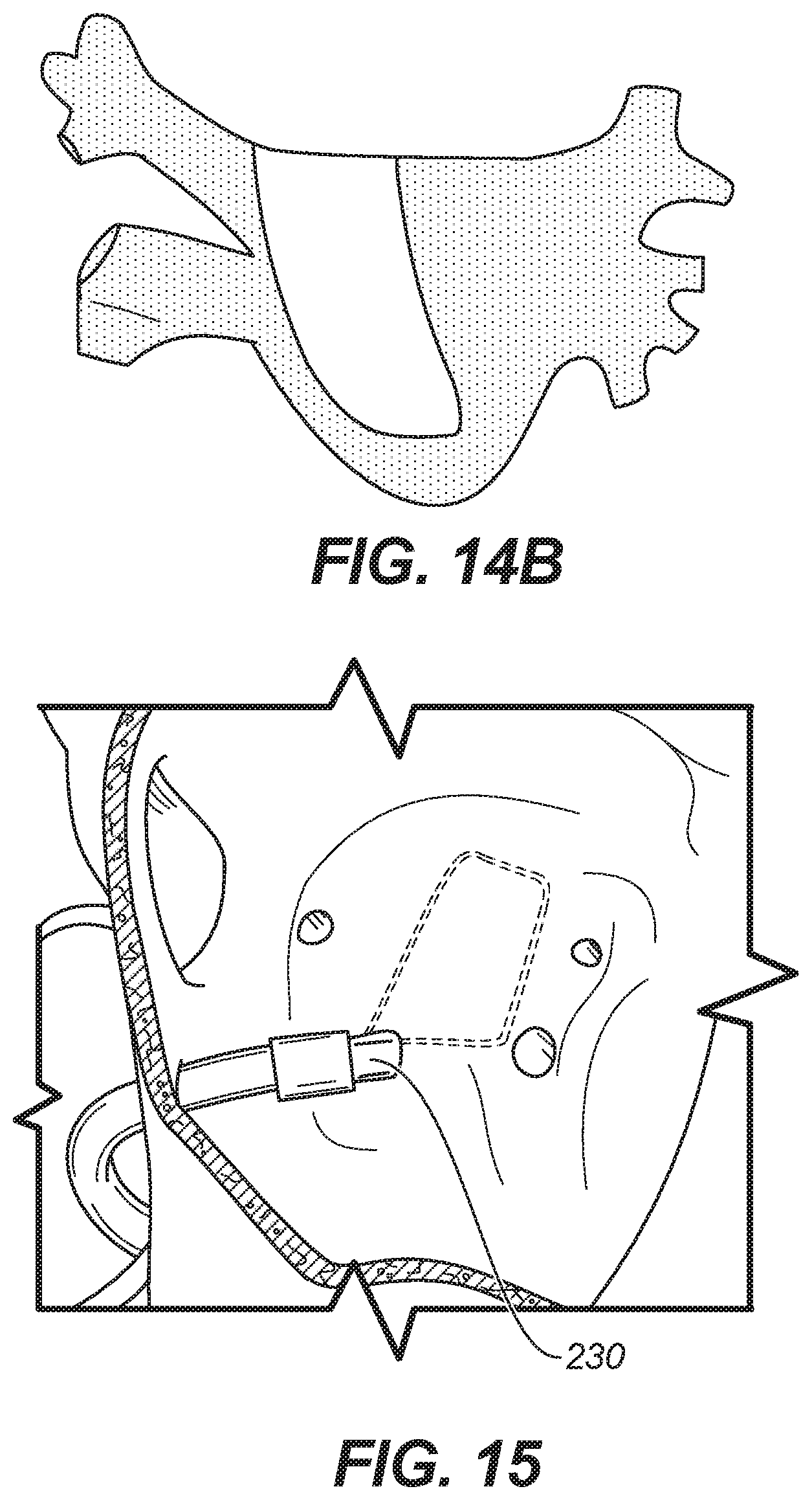 Patent US11771486 Figure 13 – Device for ablation of tissue surfaces and related systems and methods