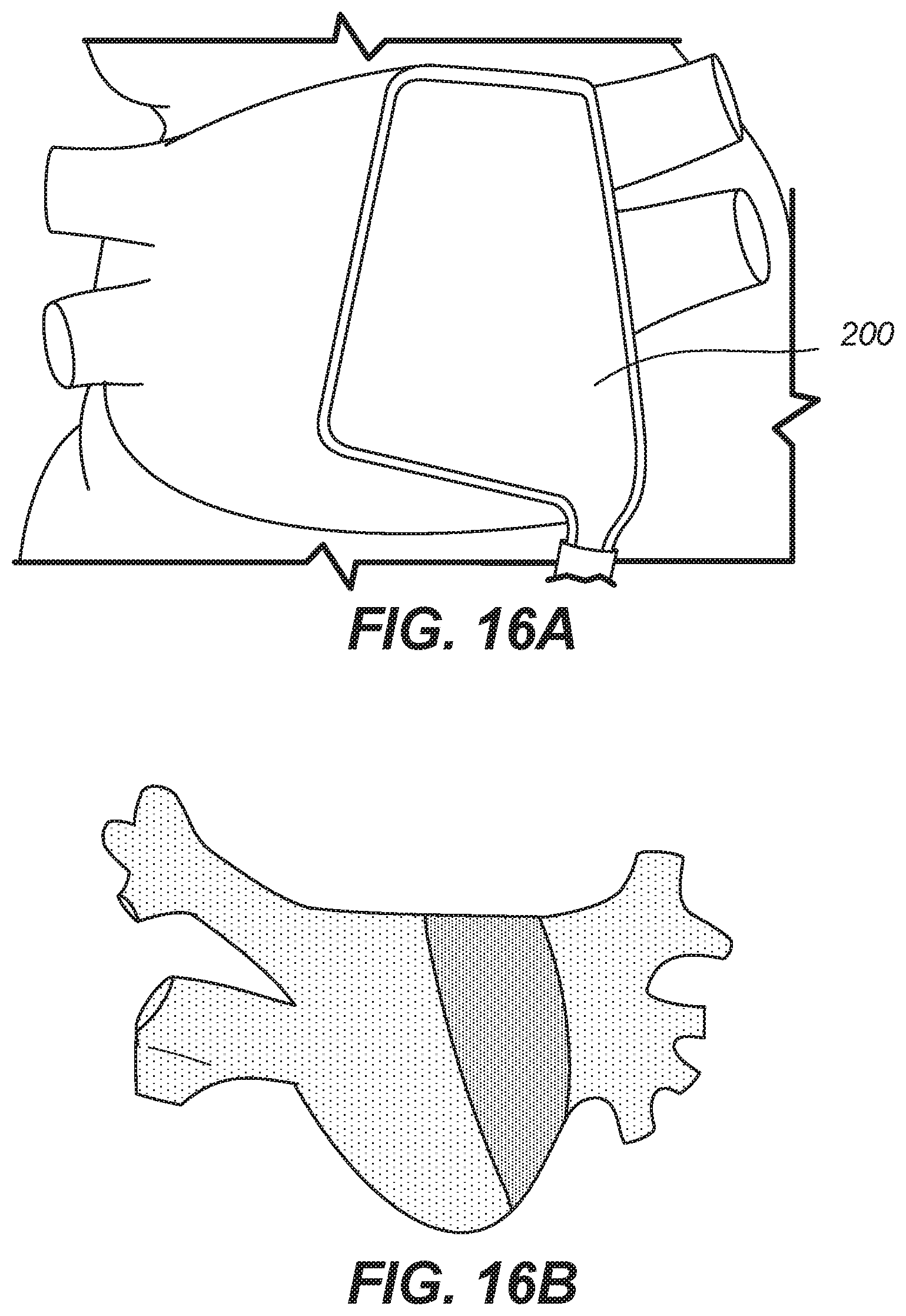 Patent US11771486 Figure 14 – Device for ablation of tissue surfaces and related systems and methods