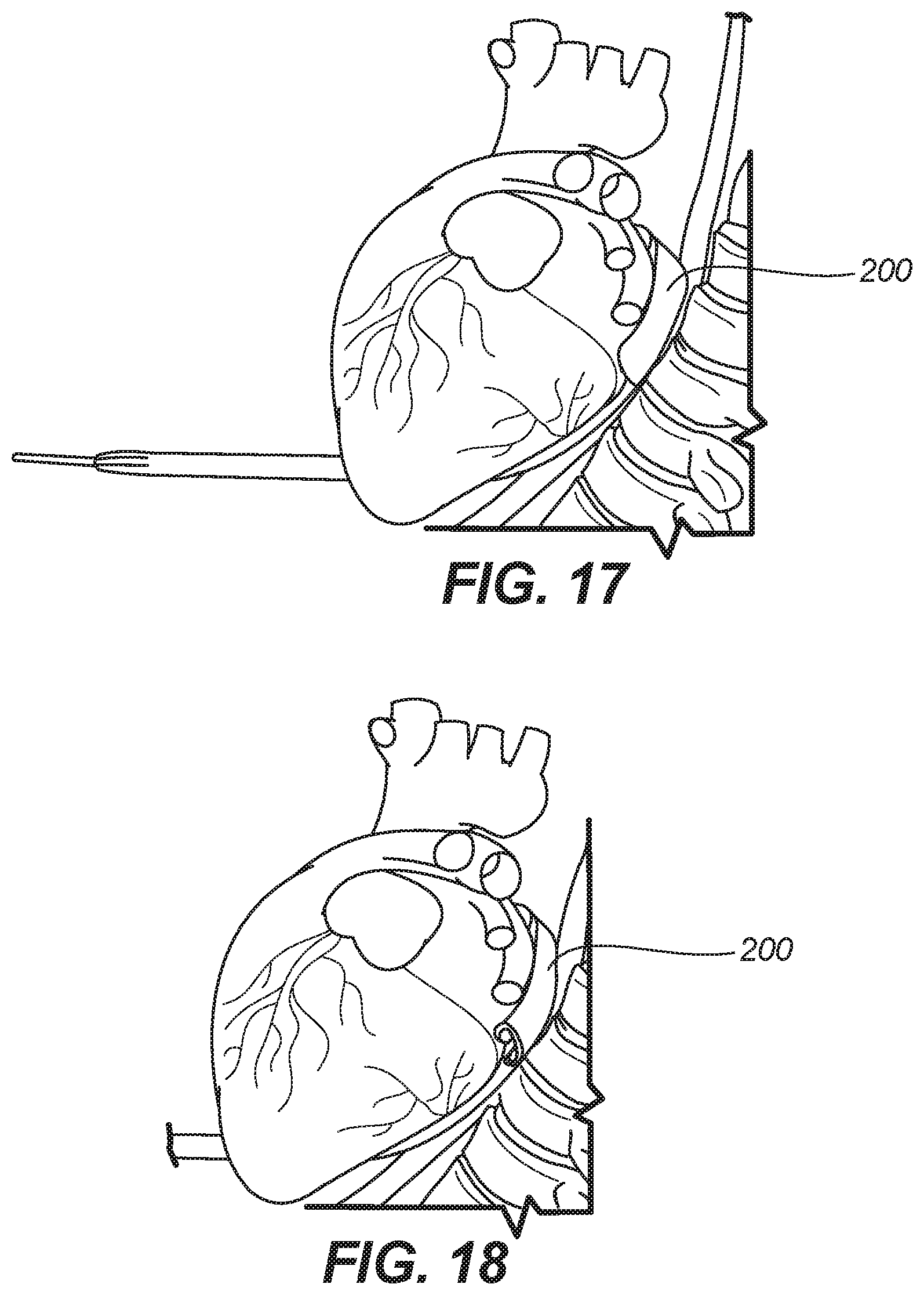 Patent US11771486 Figure 15 – Device for ablation of tissue surfaces and related systems and methods