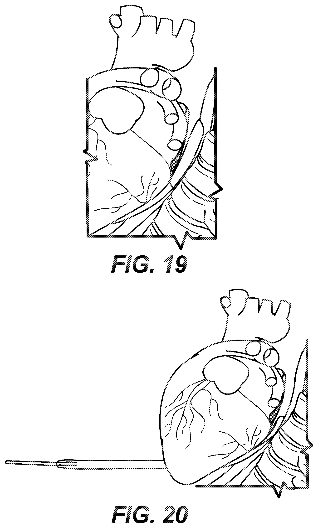 Patent US11771486 Figure 16 – Device for ablation of tissue surfaces and related systems and methods