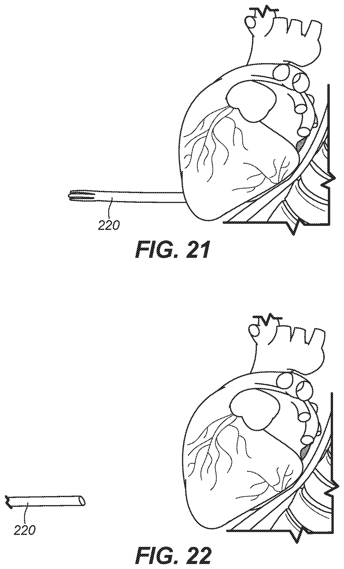 Patent US11771486 Figure 17 – Device for ablation of tissue surfaces and related systems and methods