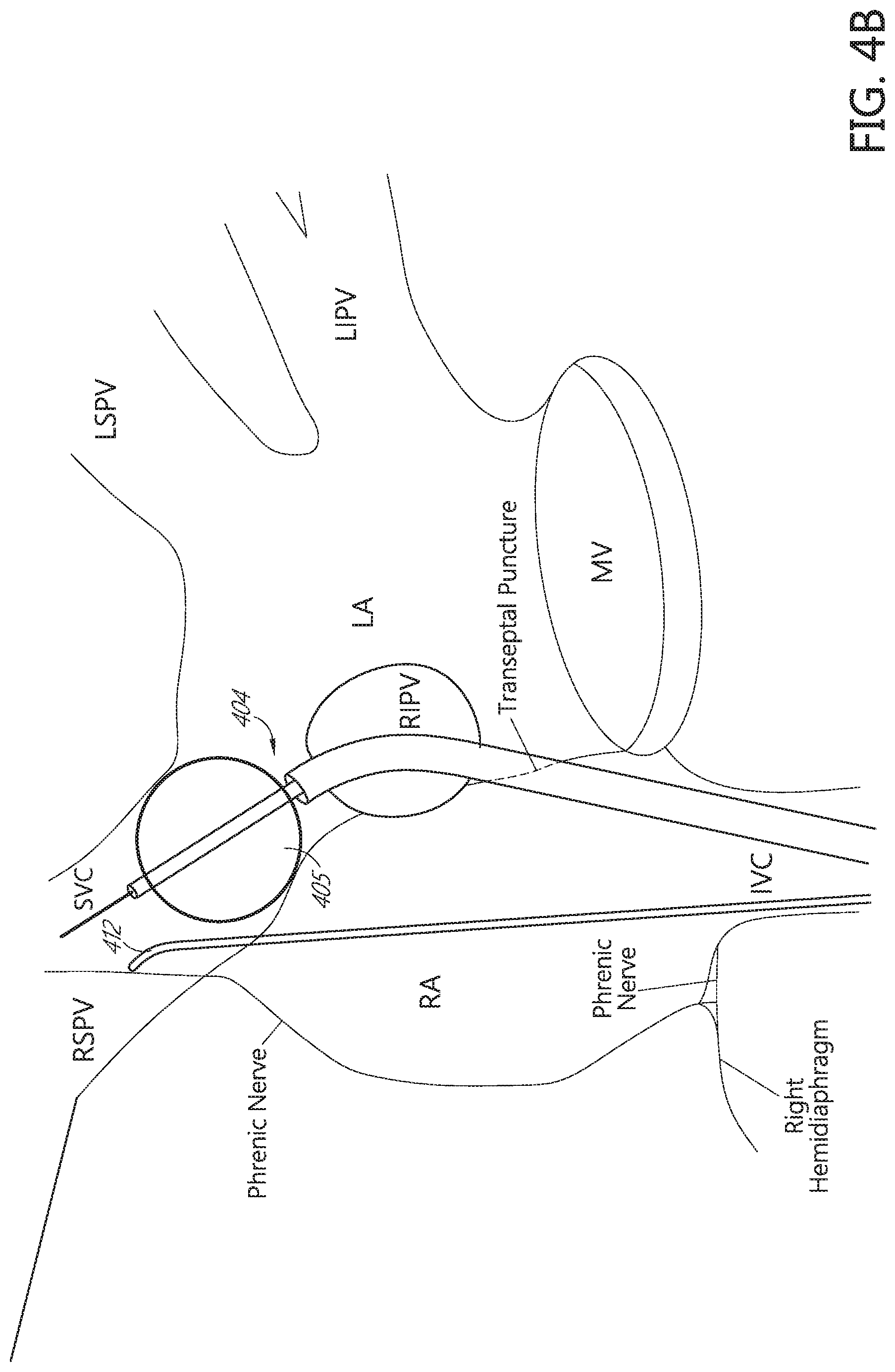 Patent US11771491 Figure 5 – Tissue mapping and treatment