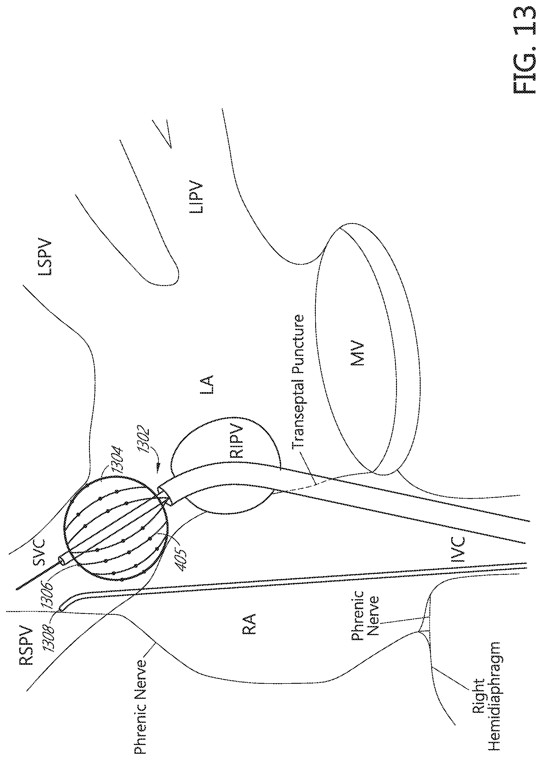 Patent US11771491 Figure 14 – Tissue mapping and treatment