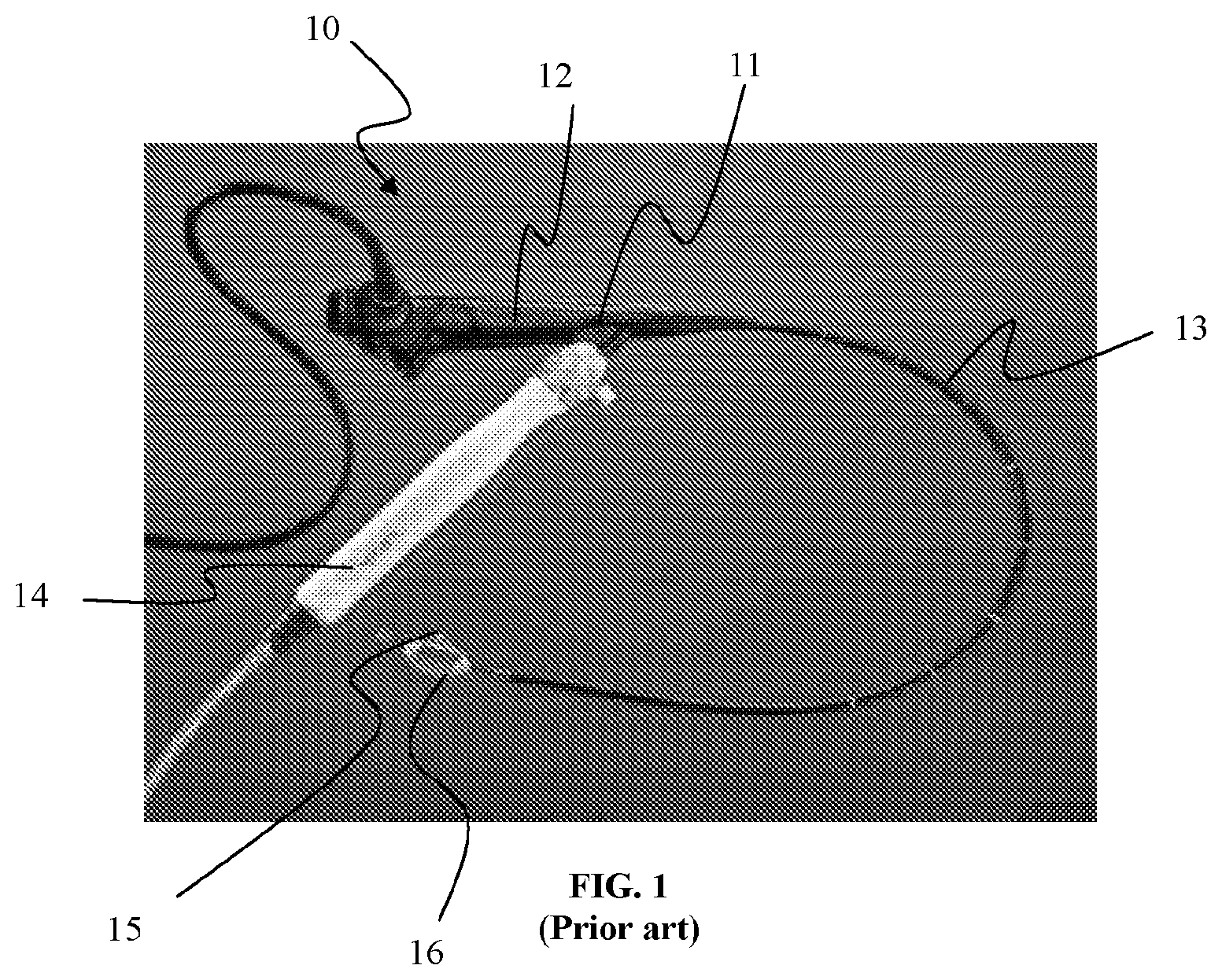 Patent US11771492 Figure 1 – Systems and methods for improved delivery of expandable catheter assemblies into body lumens
