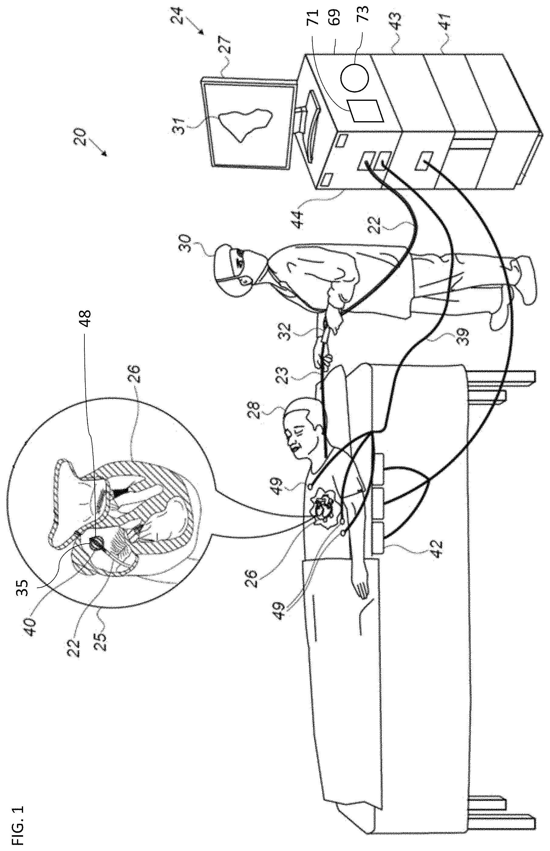 Patent US11771495 Figure 1 – Basket catheter with balloon