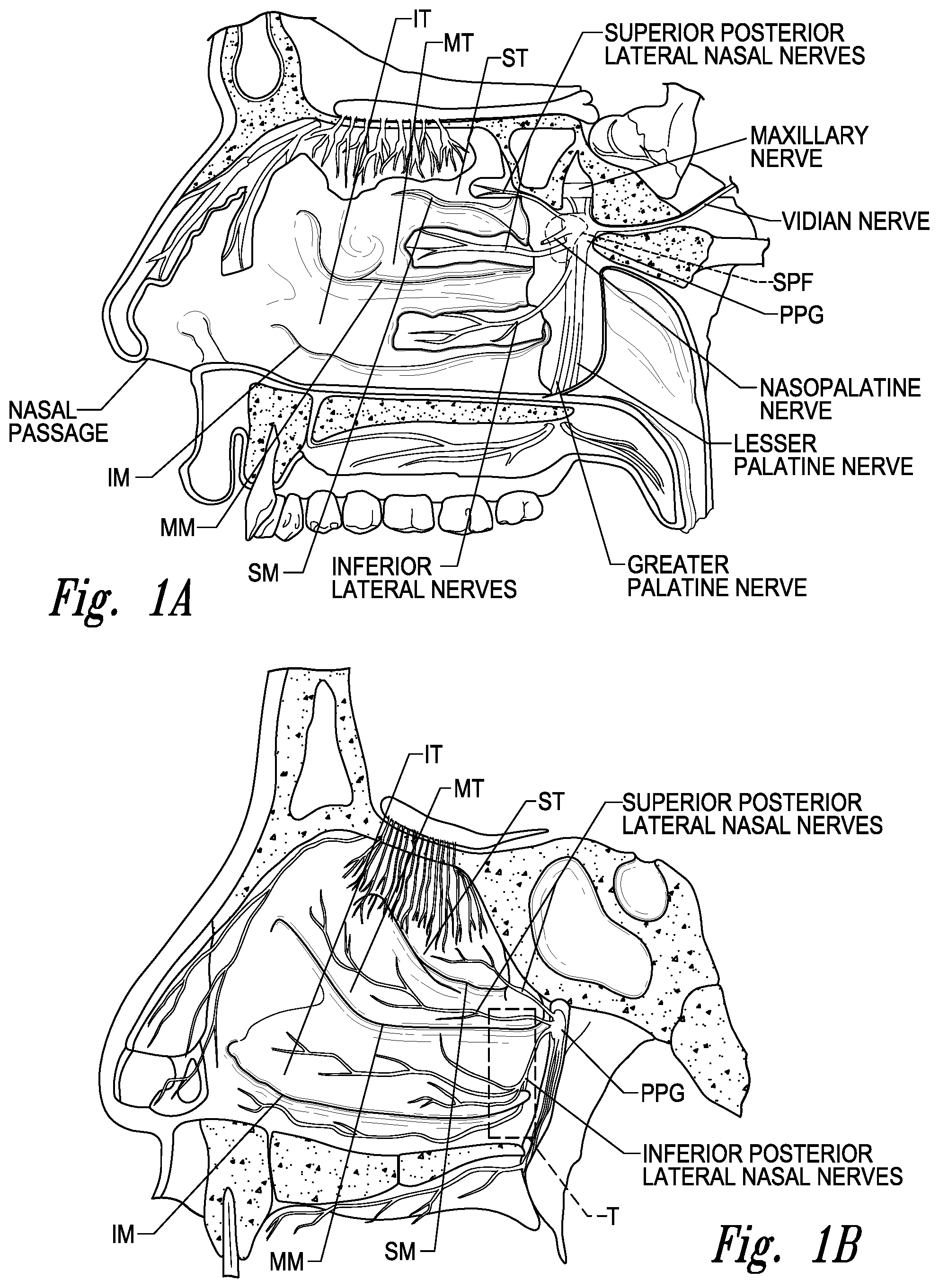 Patent US11771497 Figure 1 – Devices for therapeutic nasal neuromodulation and associated methods and systems