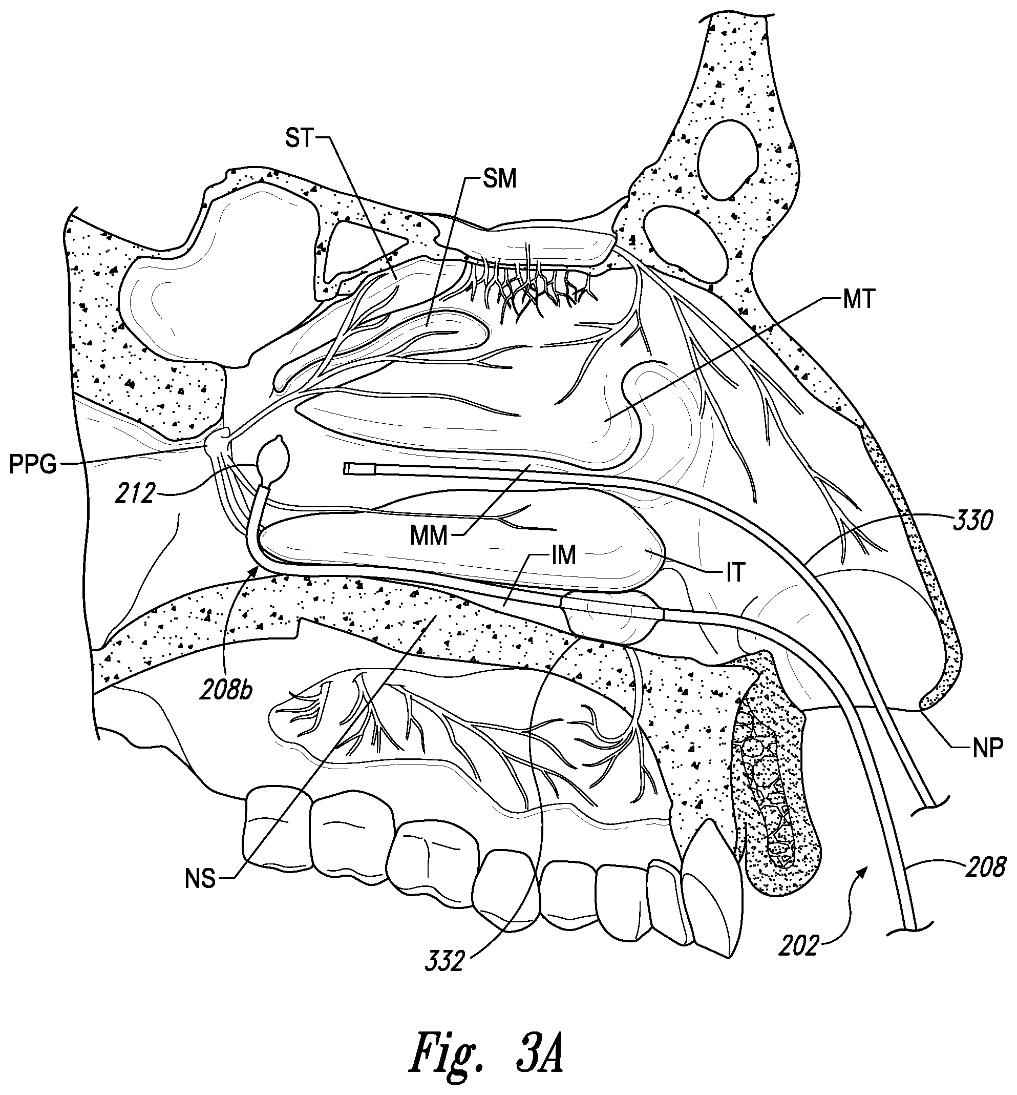 Patent US11771497 Figure 4 – Devices for therapeutic nasal neuromodulation and associated methods and systems