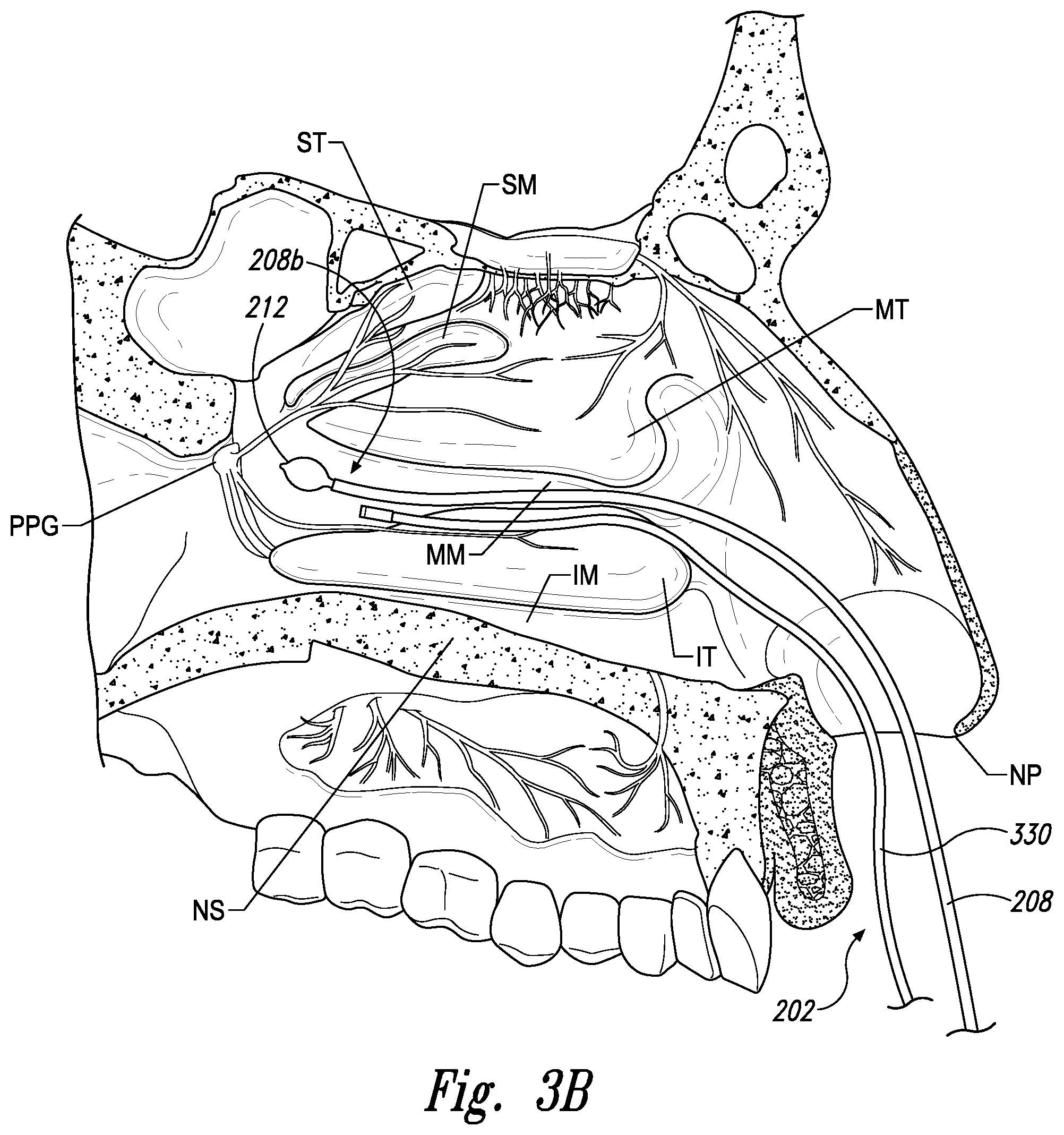 Patent US11771497 Figure 5 – Devices for therapeutic nasal neuromodulation and associated methods and systems
