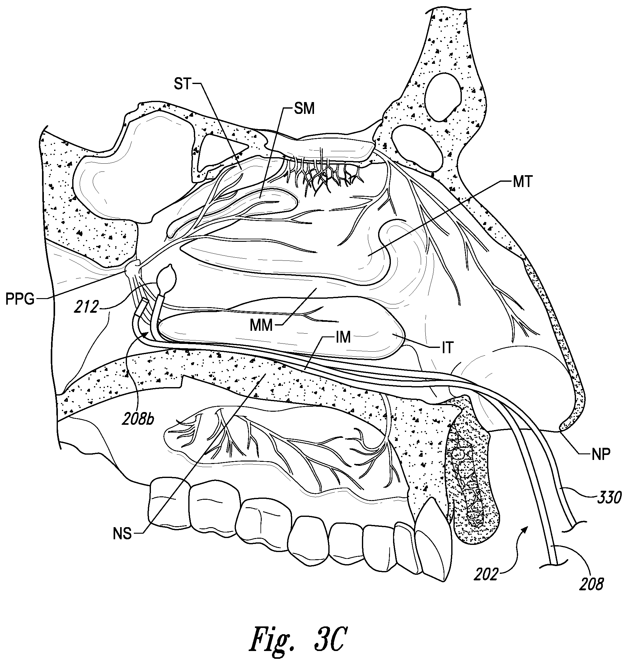 Patent US11771497 Figure 6 – Devices for therapeutic nasal neuromodulation and associated methods and systems
