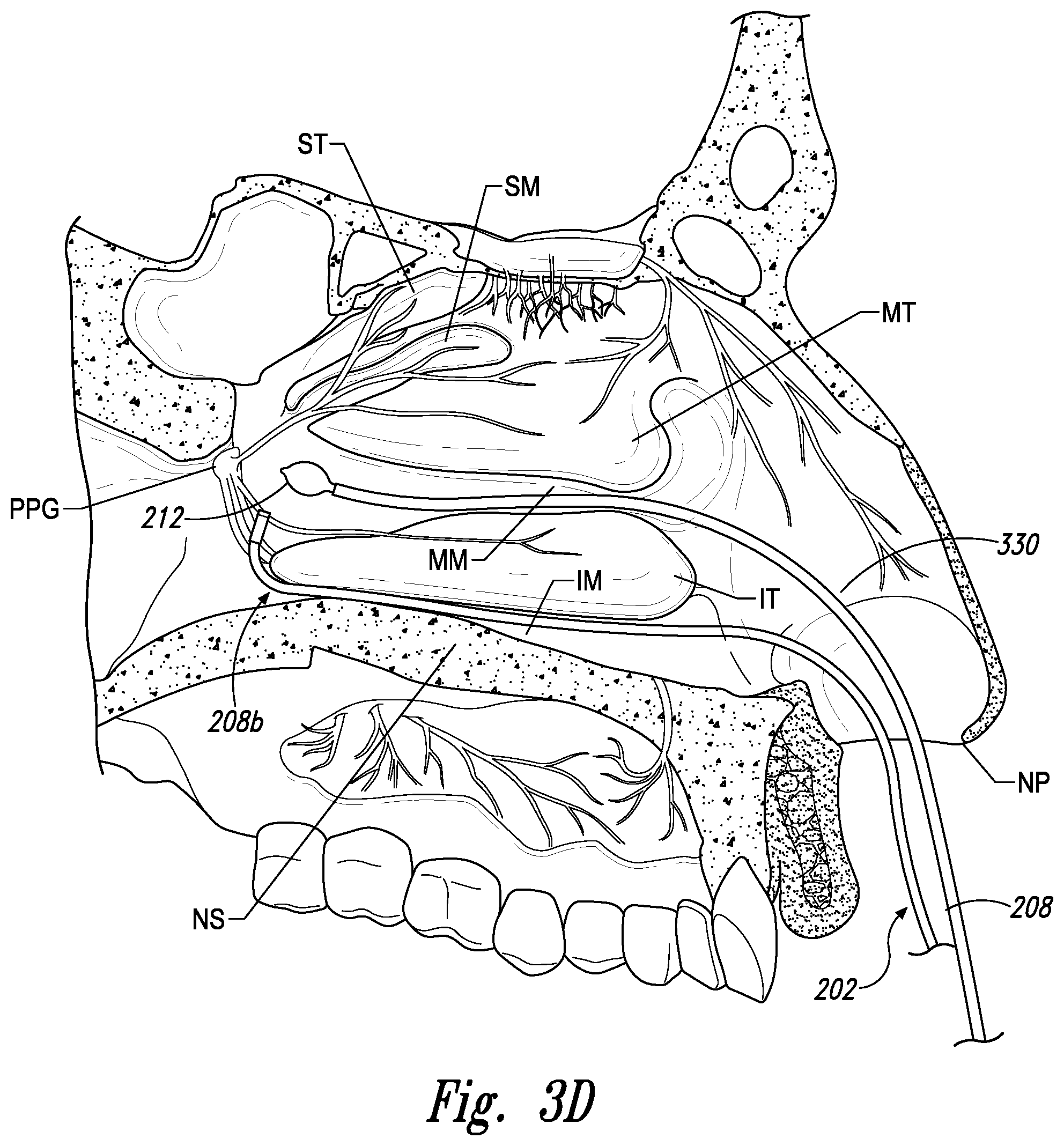 Patent US11771497 Figure 7 – Devices for therapeutic nasal neuromodulation and associated methods and systems