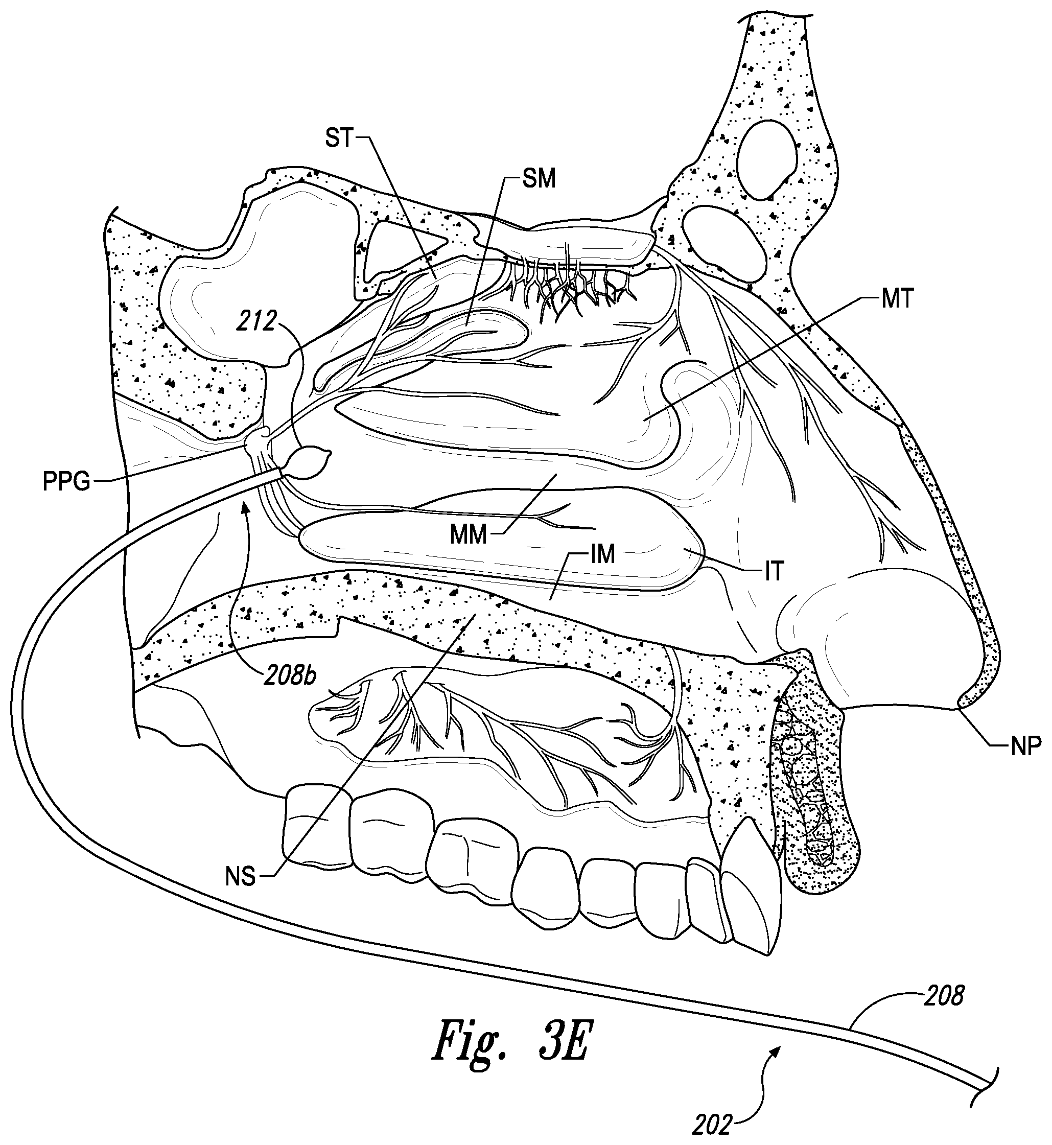 Patent US11771497 Figure 8 – Devices for therapeutic nasal neuromodulation and associated methods and systems