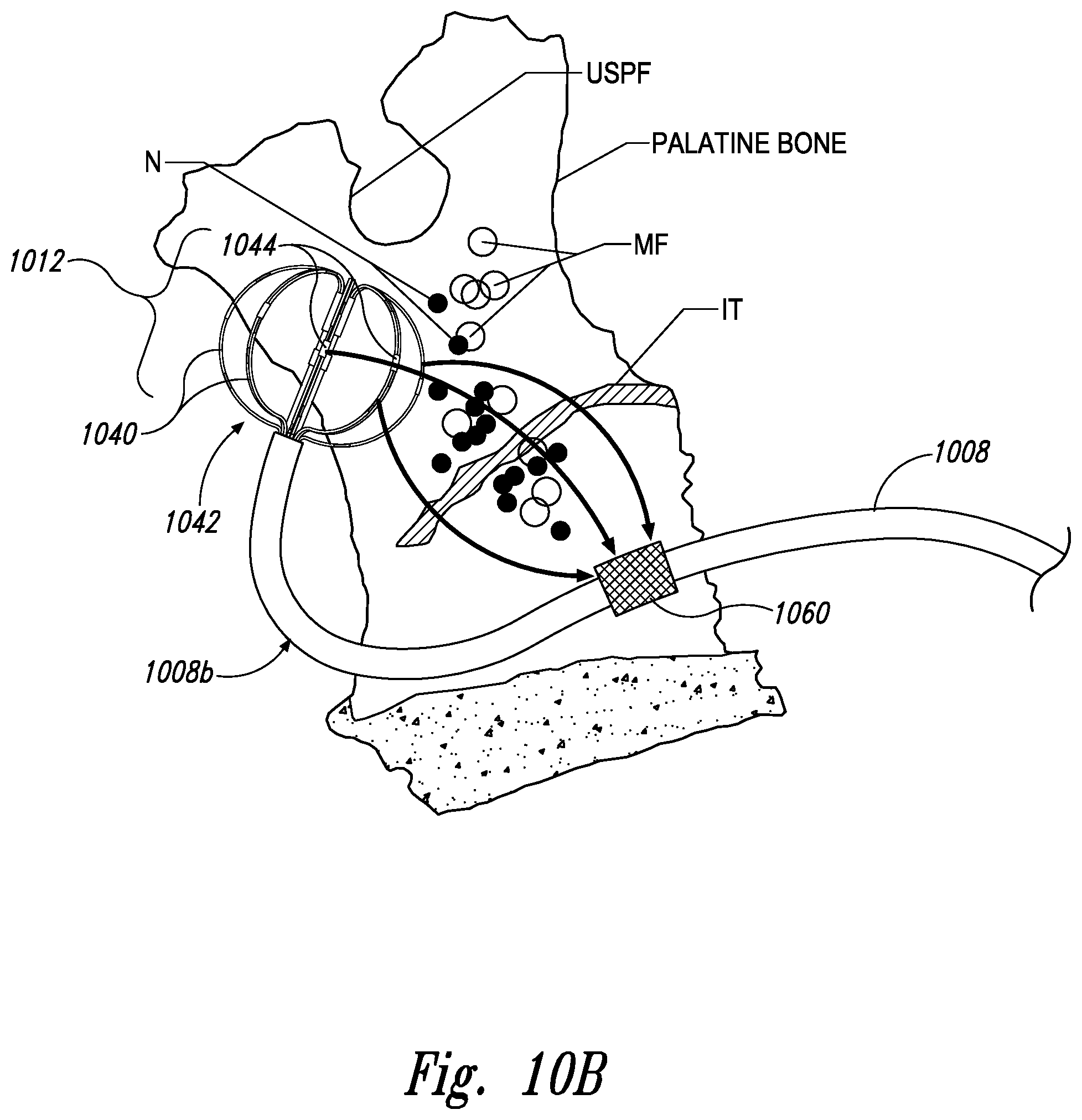 Patent US11771497 Figure 20 – Devices for therapeutic nasal neuromodulation and associated methods and systems