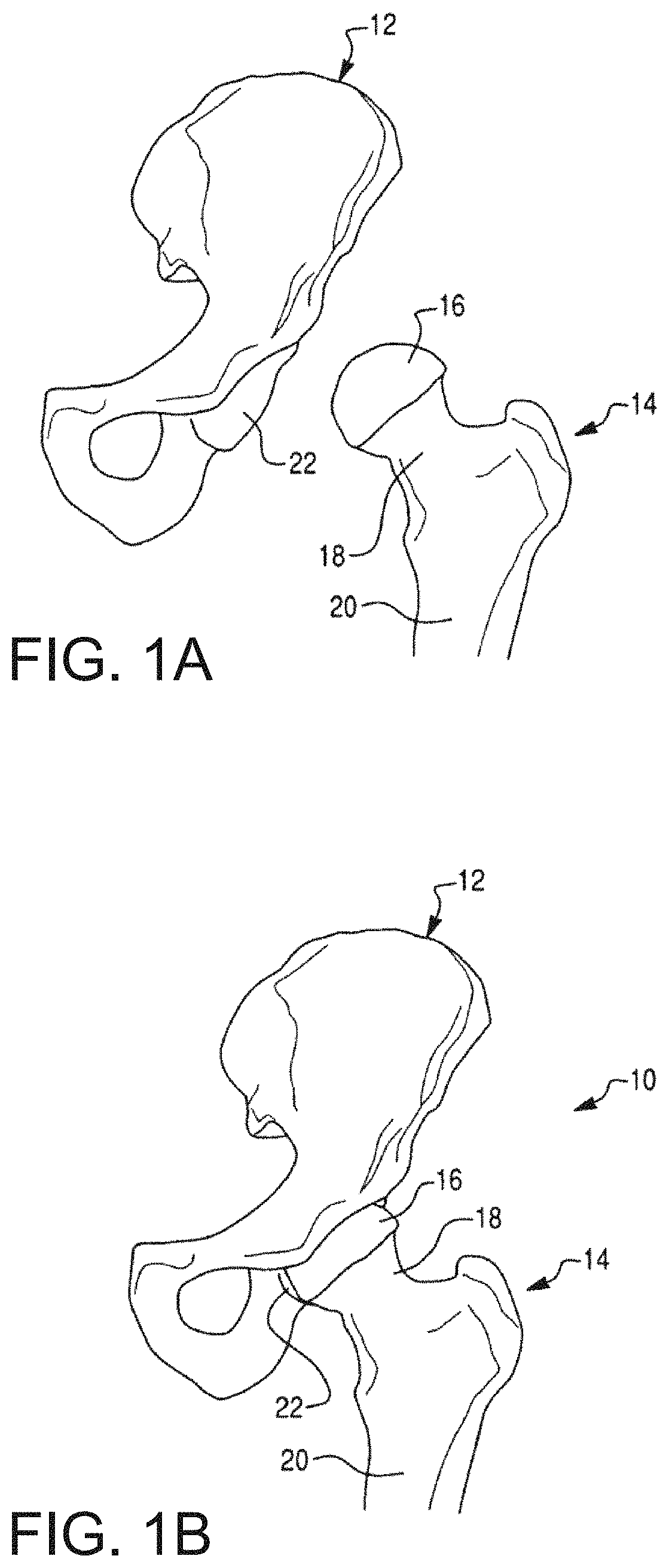 Patent US11771498 Figure 1 – Lower extremities leg length calculation method