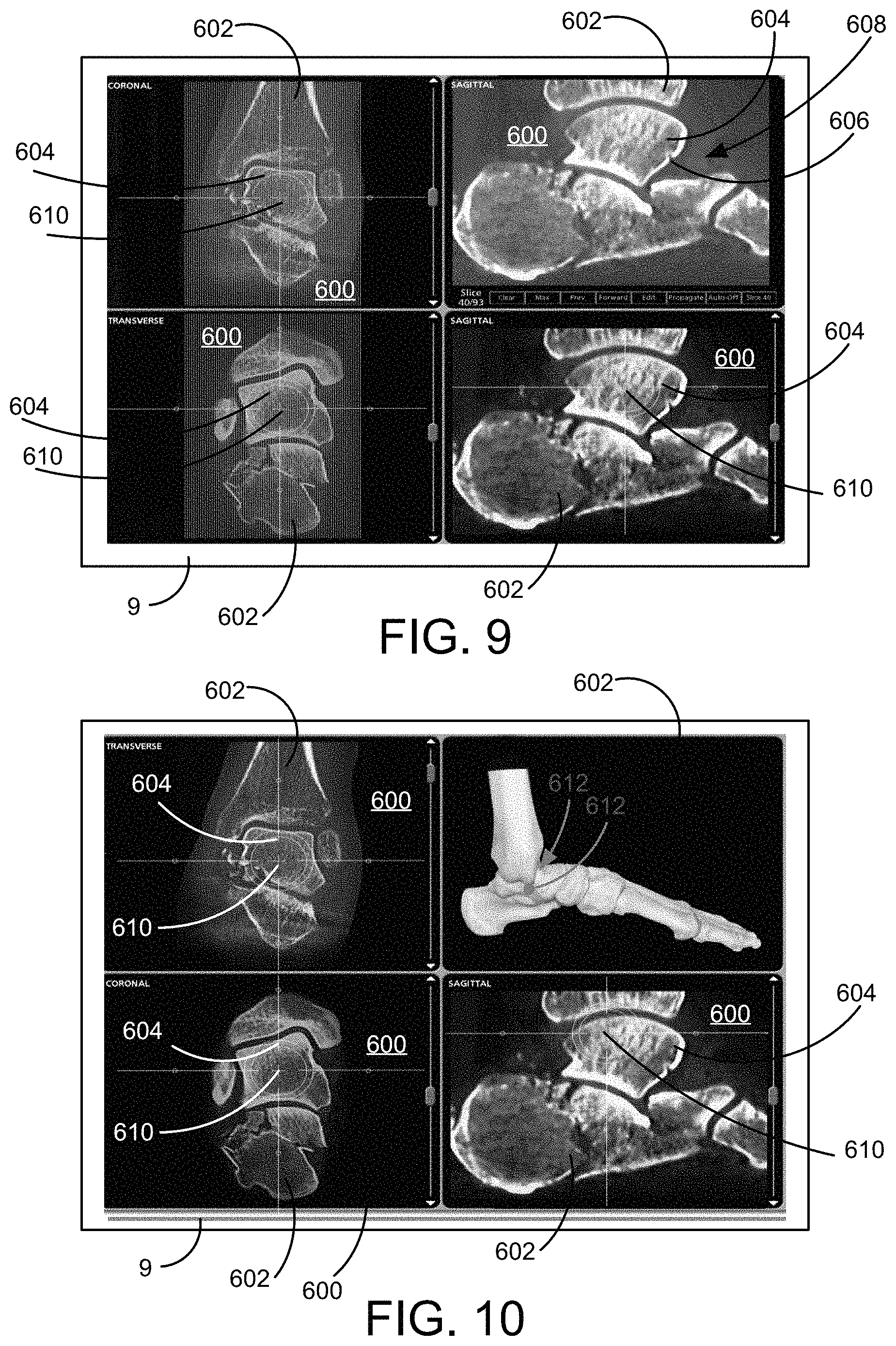 Patent US11771498 Figure 11 – Lower extremities leg length calculation method