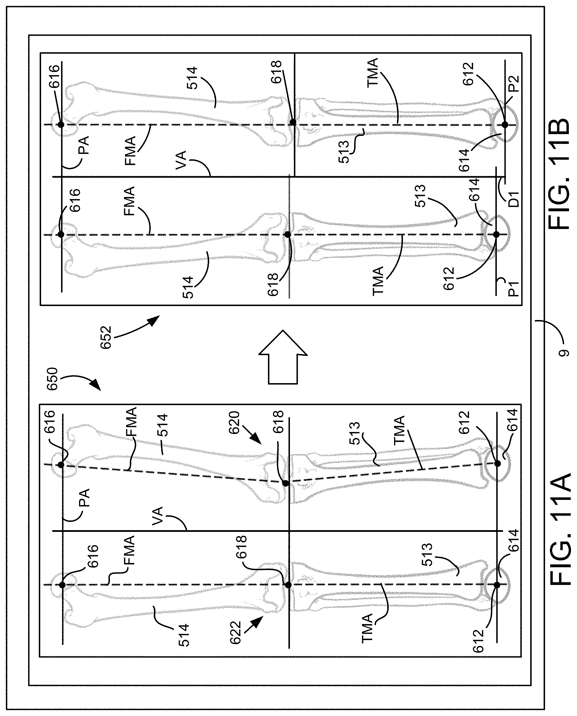 Patent US11771498 Figure 12 – Lower extremities leg length calculation method
