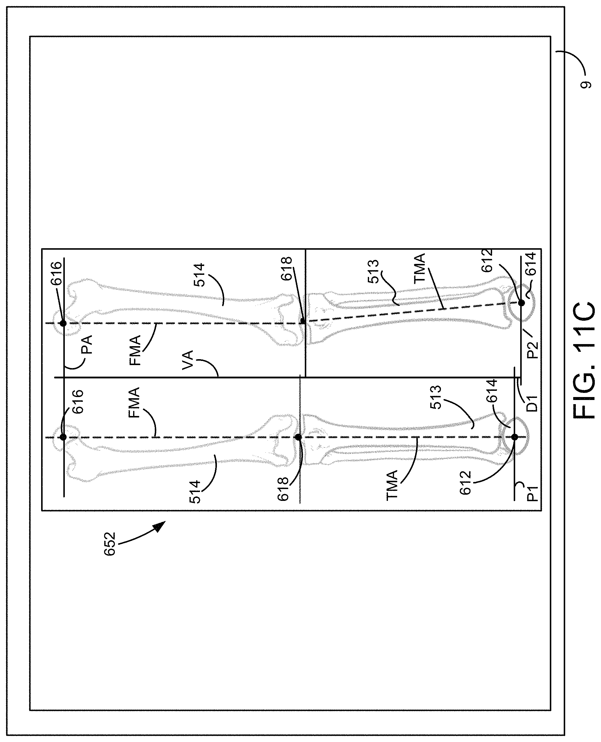Patent US11771498 Figure 13 – Lower extremities leg length calculation method