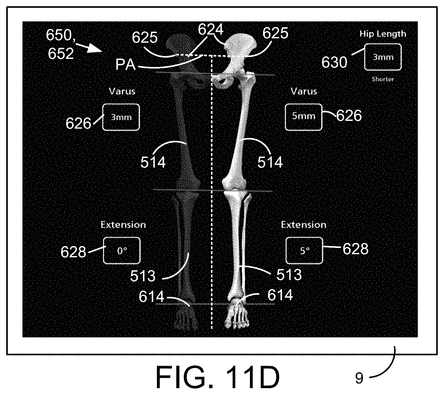 Patent US11771498 Figure 14 – Lower extremities leg length calculation method