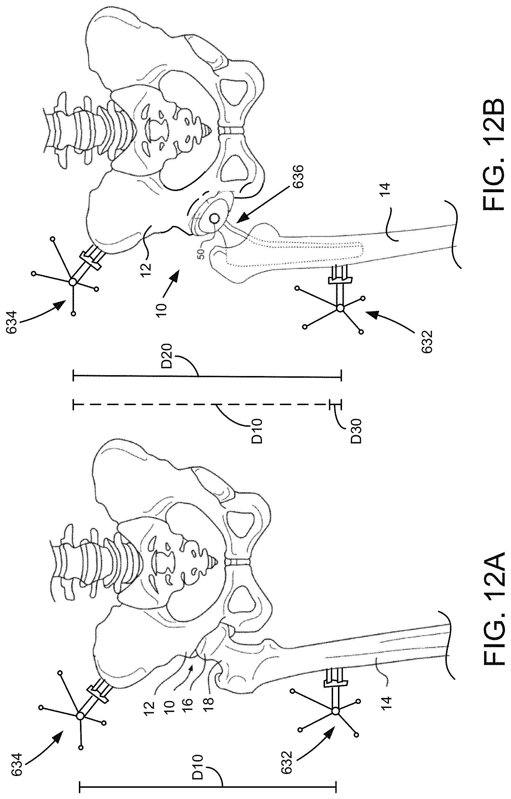 Patent US11771498 Figure 15 – Lower extremities leg length calculation method